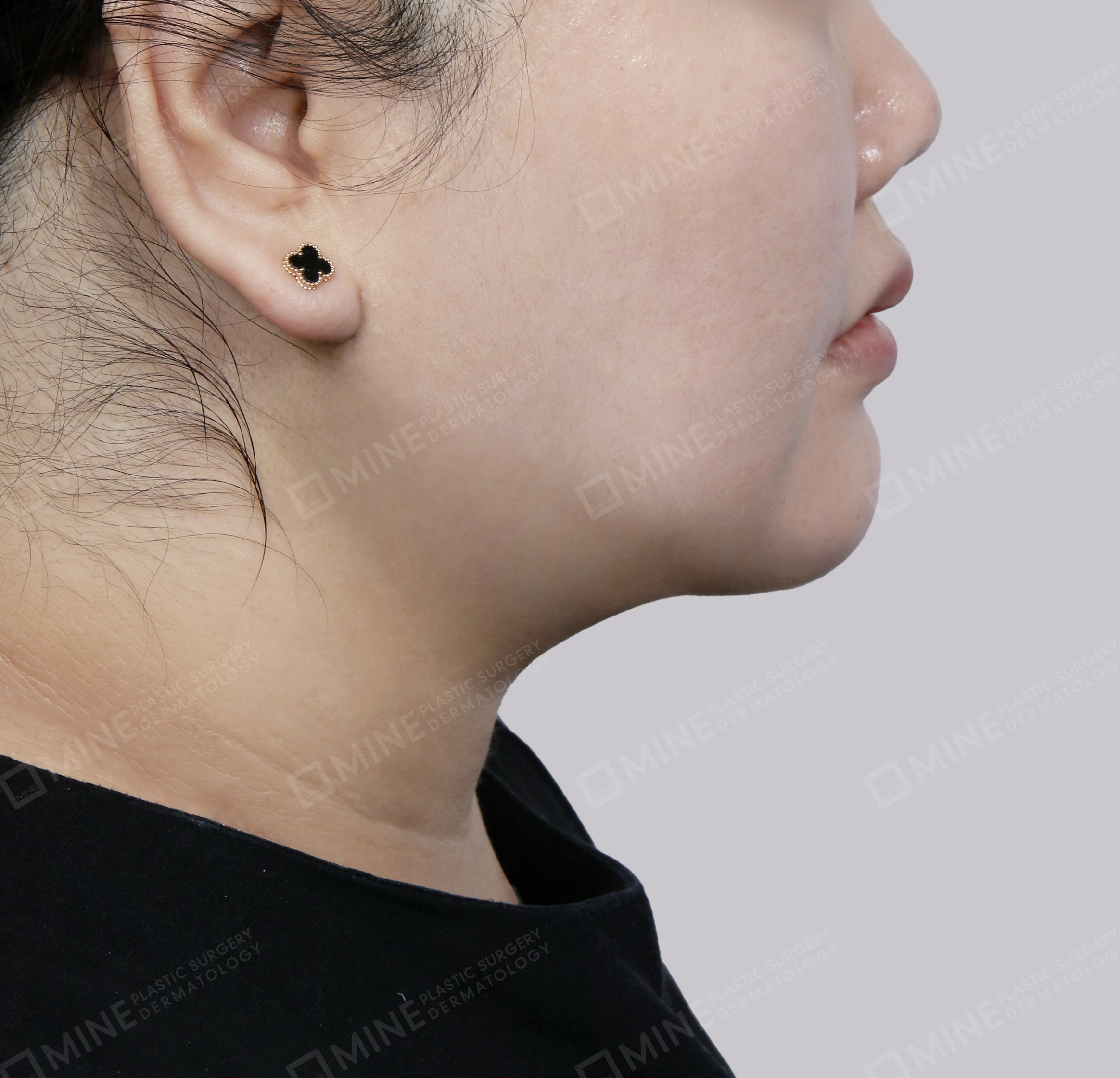 Mini Neck Lift-Side-After