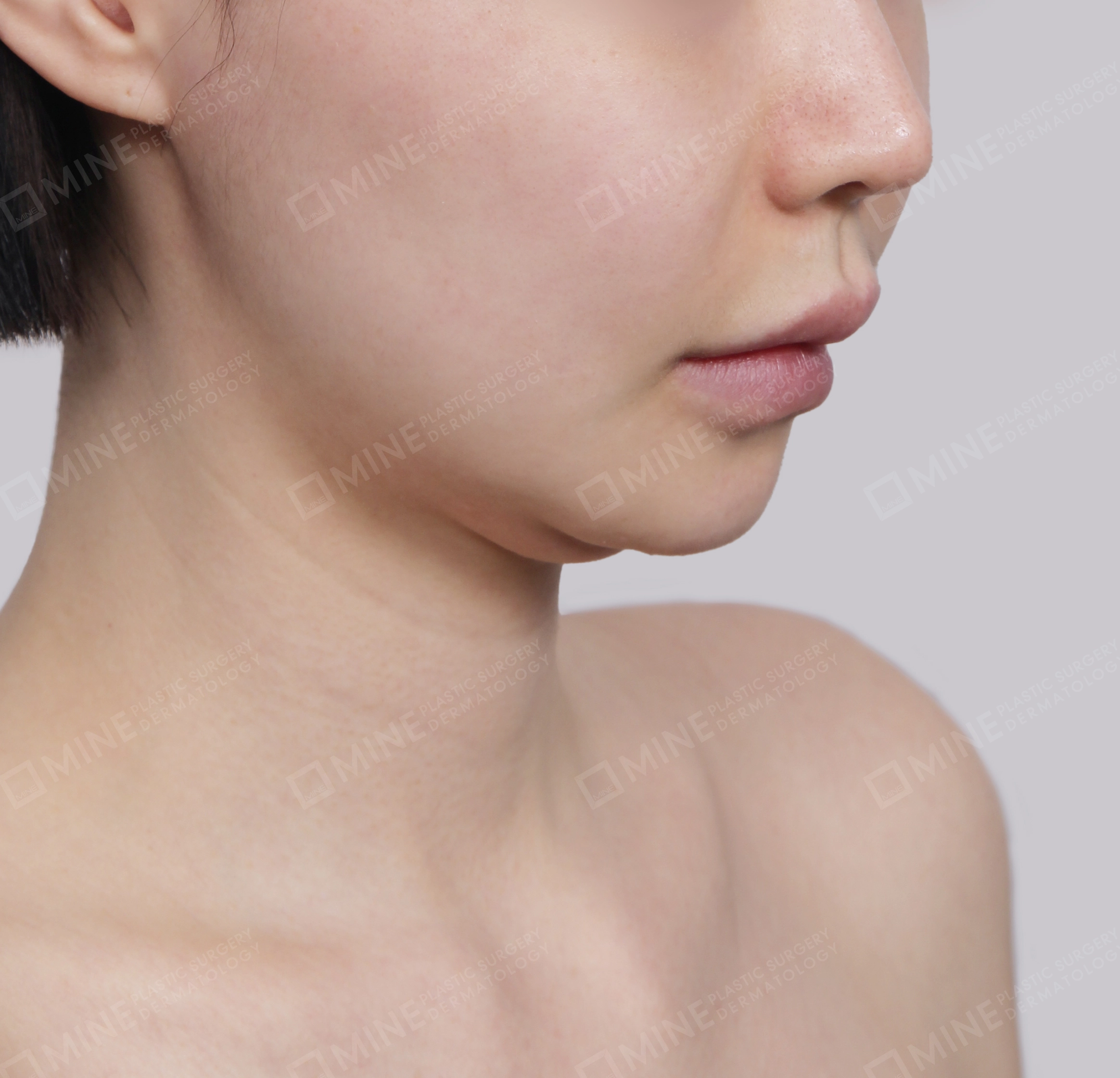 Mini Neck Lift-Front-Before