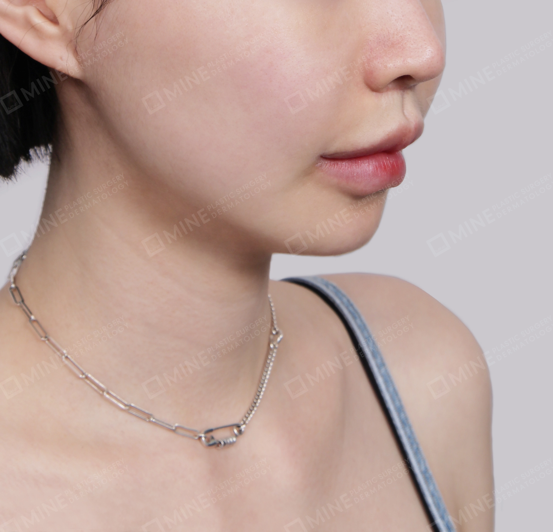 Mini Neck Lift-Front-After