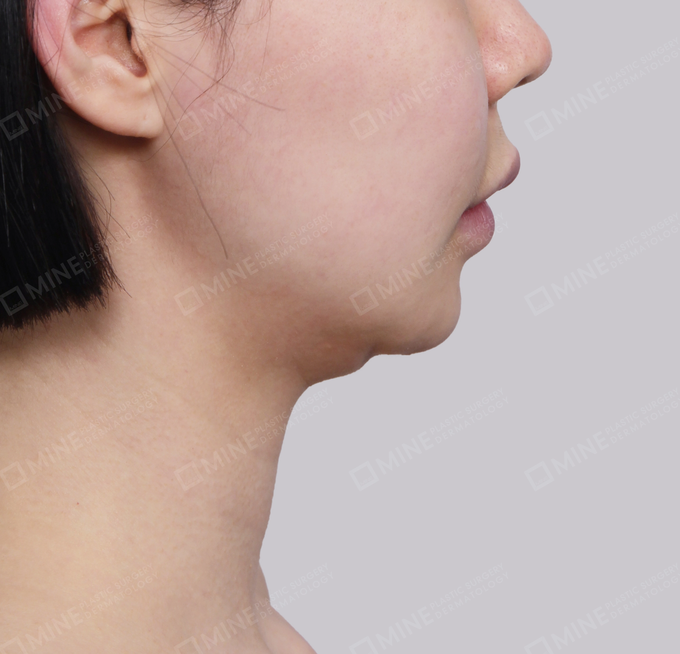 Mini Neck Lift-Side-Before