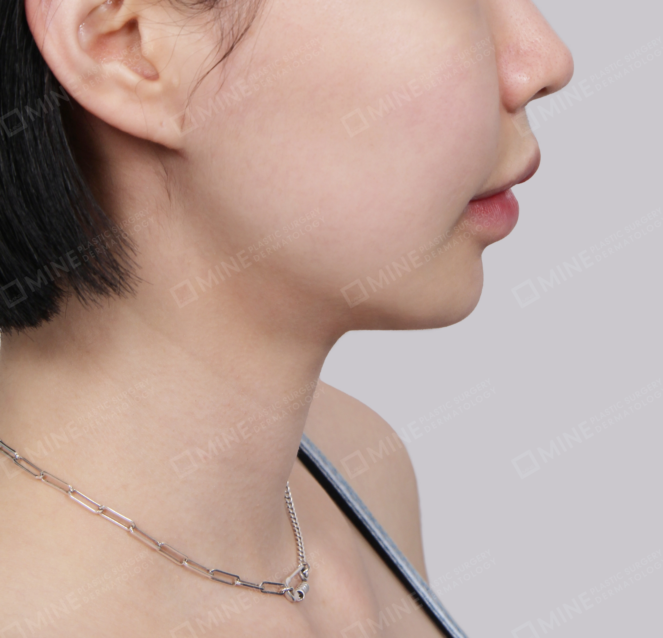 Mini Neck Lift-Side-After