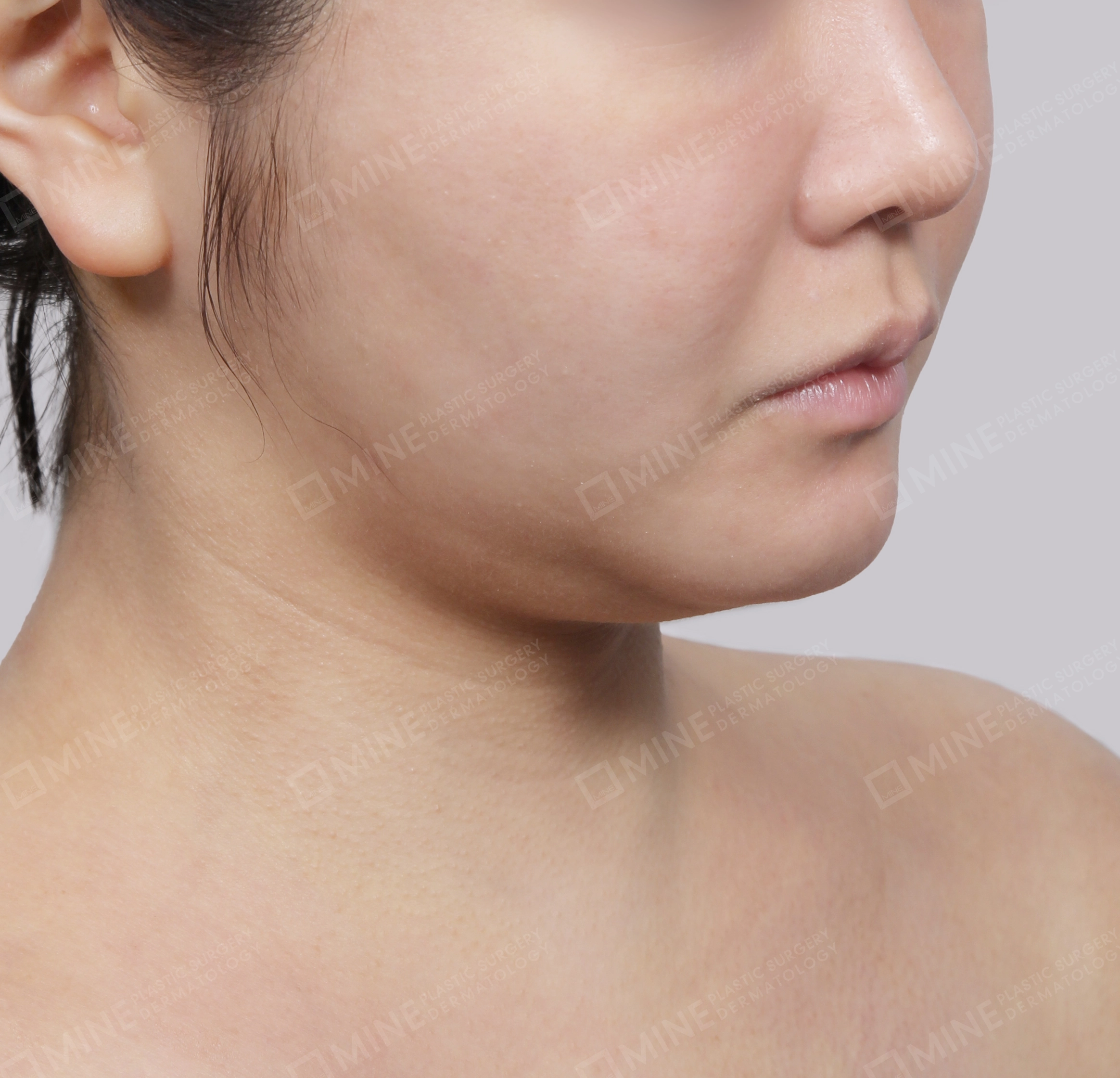 Mini Neck Lift-Front-Before