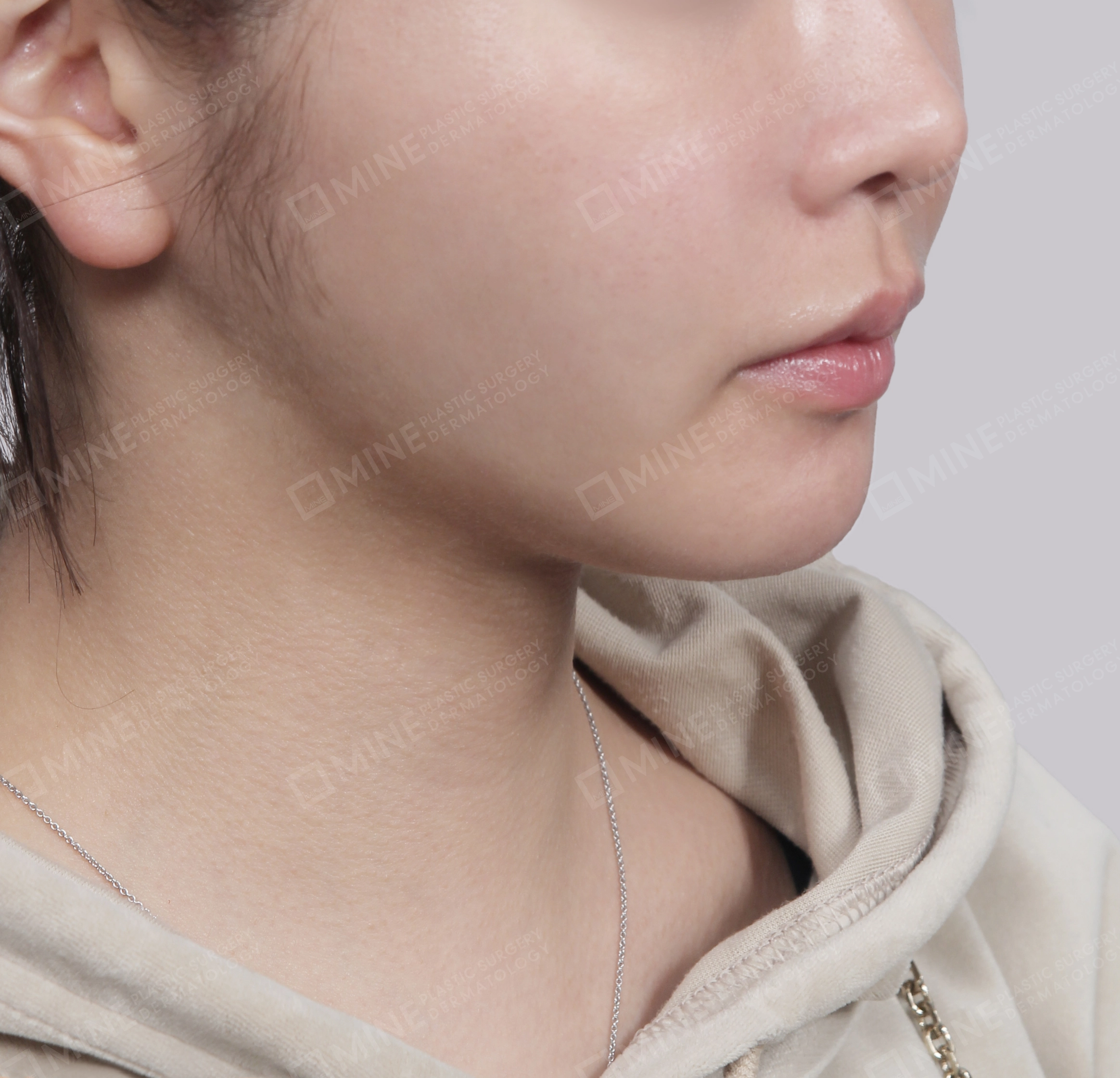 Mini Neck Lift-Front-After