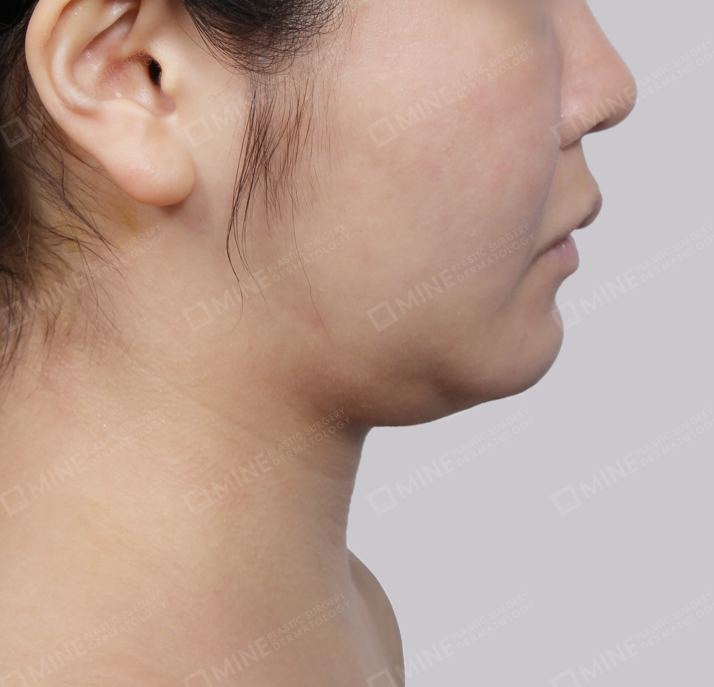 Mini Neck Lift-Side-Before