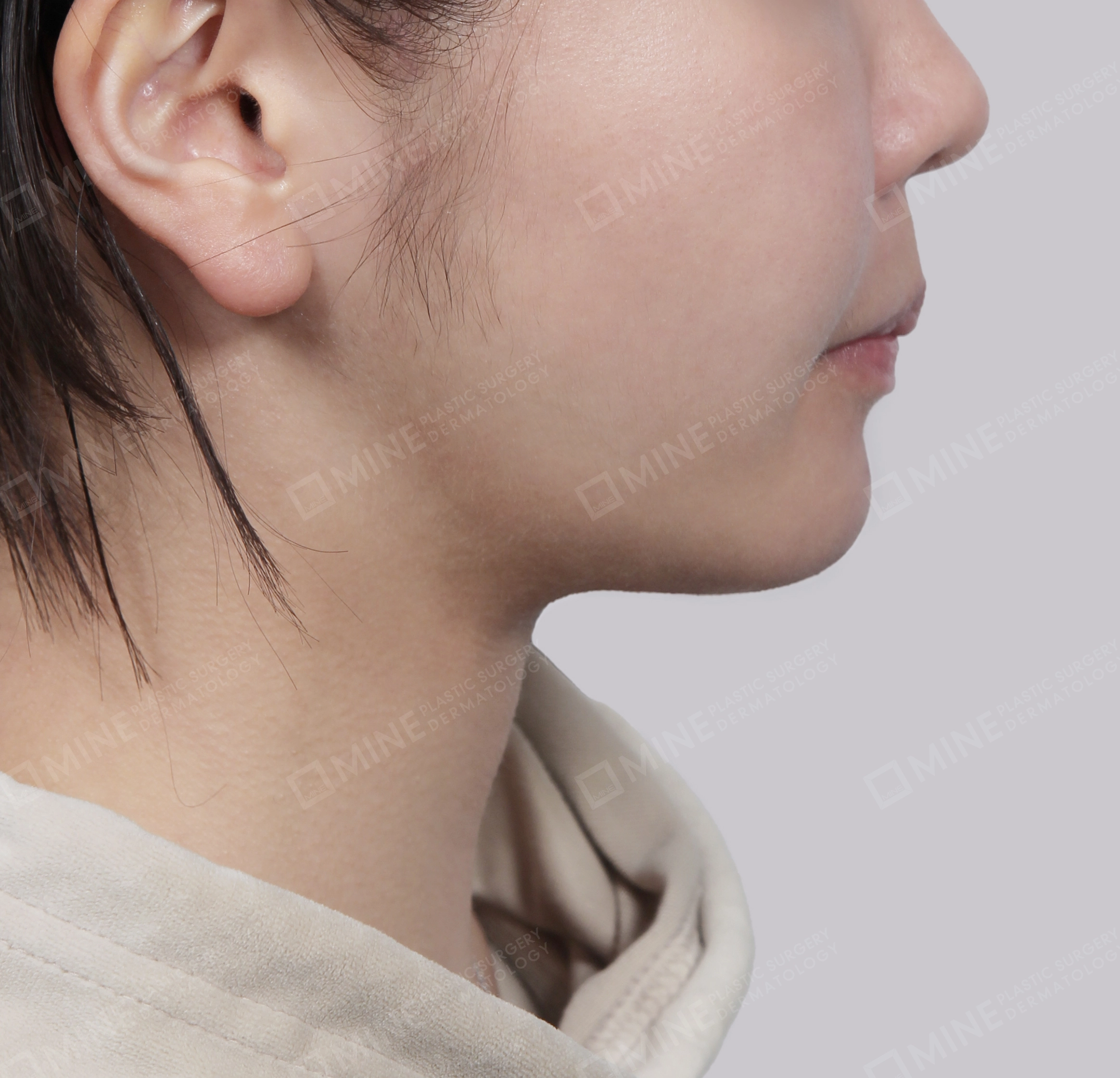 Mini Neck Lift-Side-After
