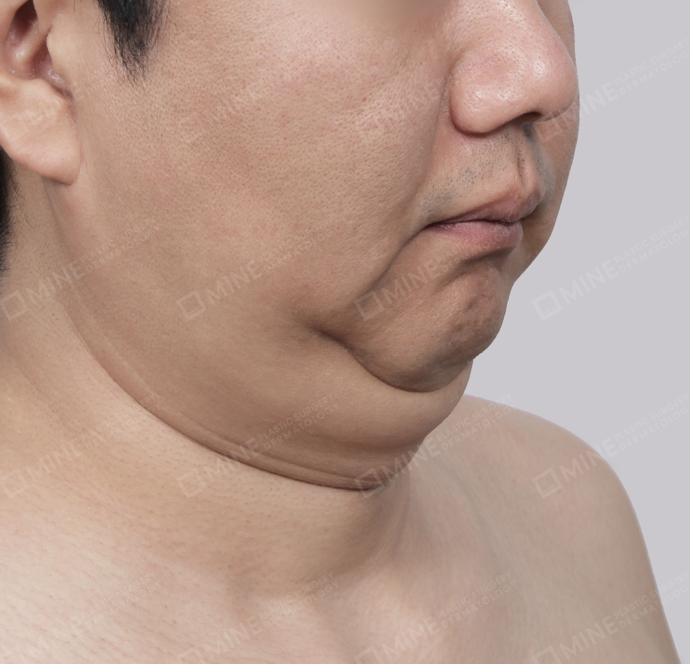 Mini Neck Lift-Front-Before
