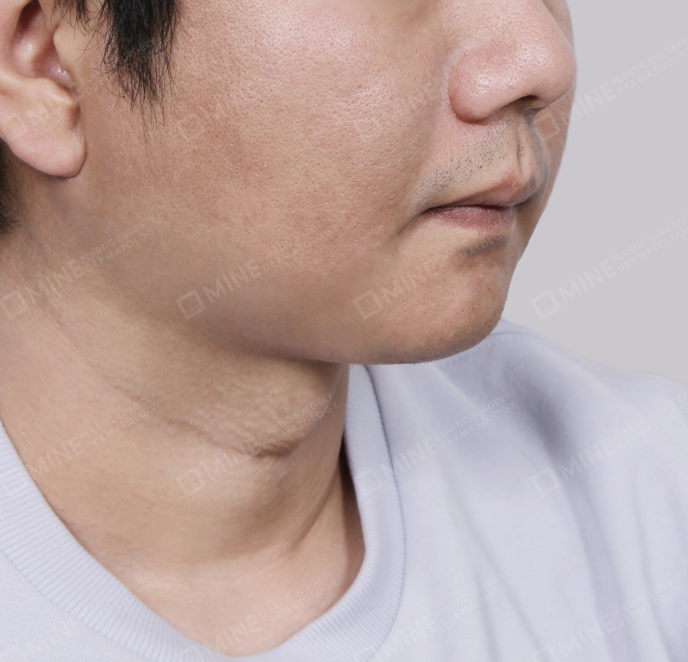 Mini Neck Lift-Front-After