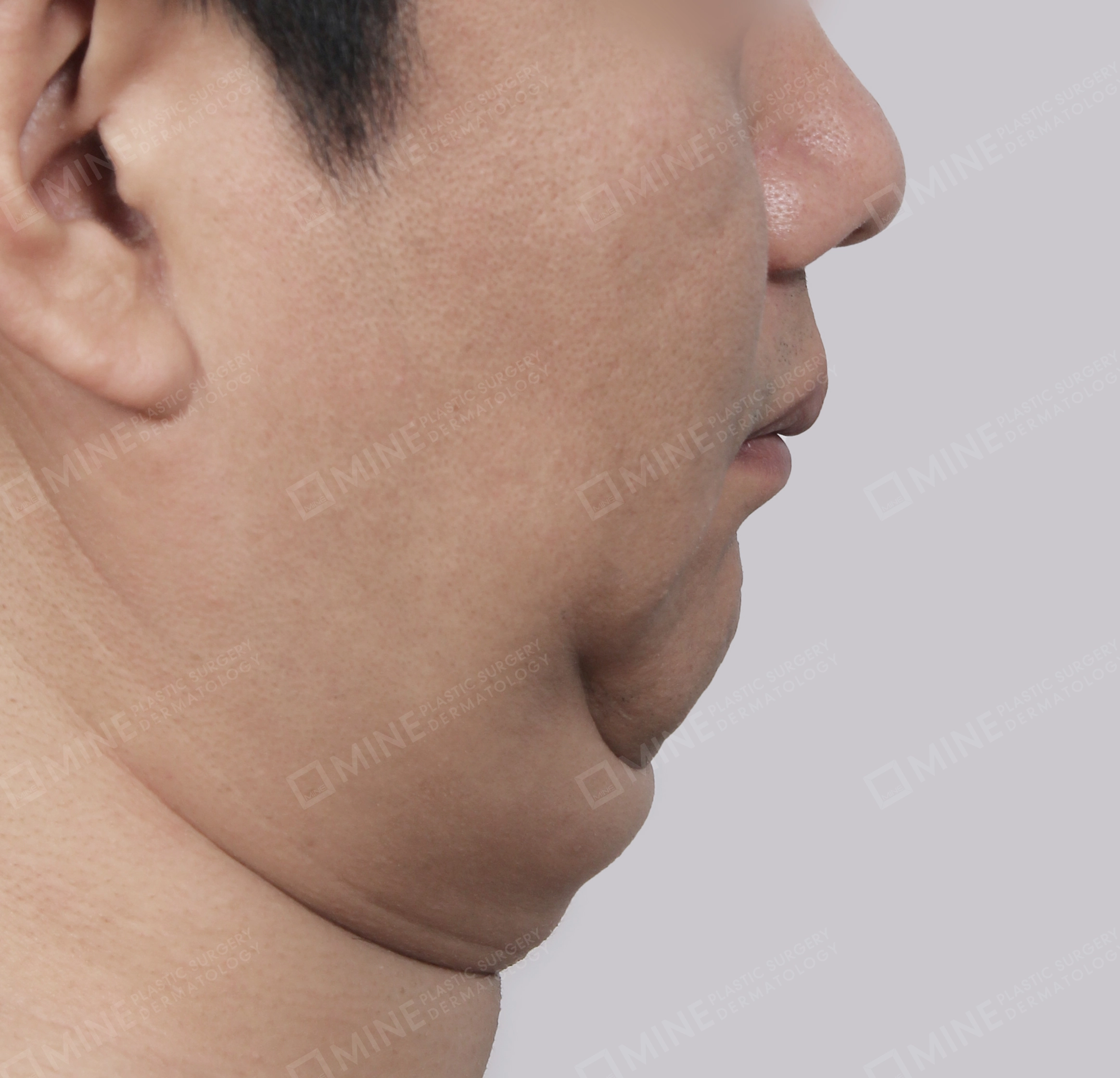 Mini Neck Lift-Side-Before