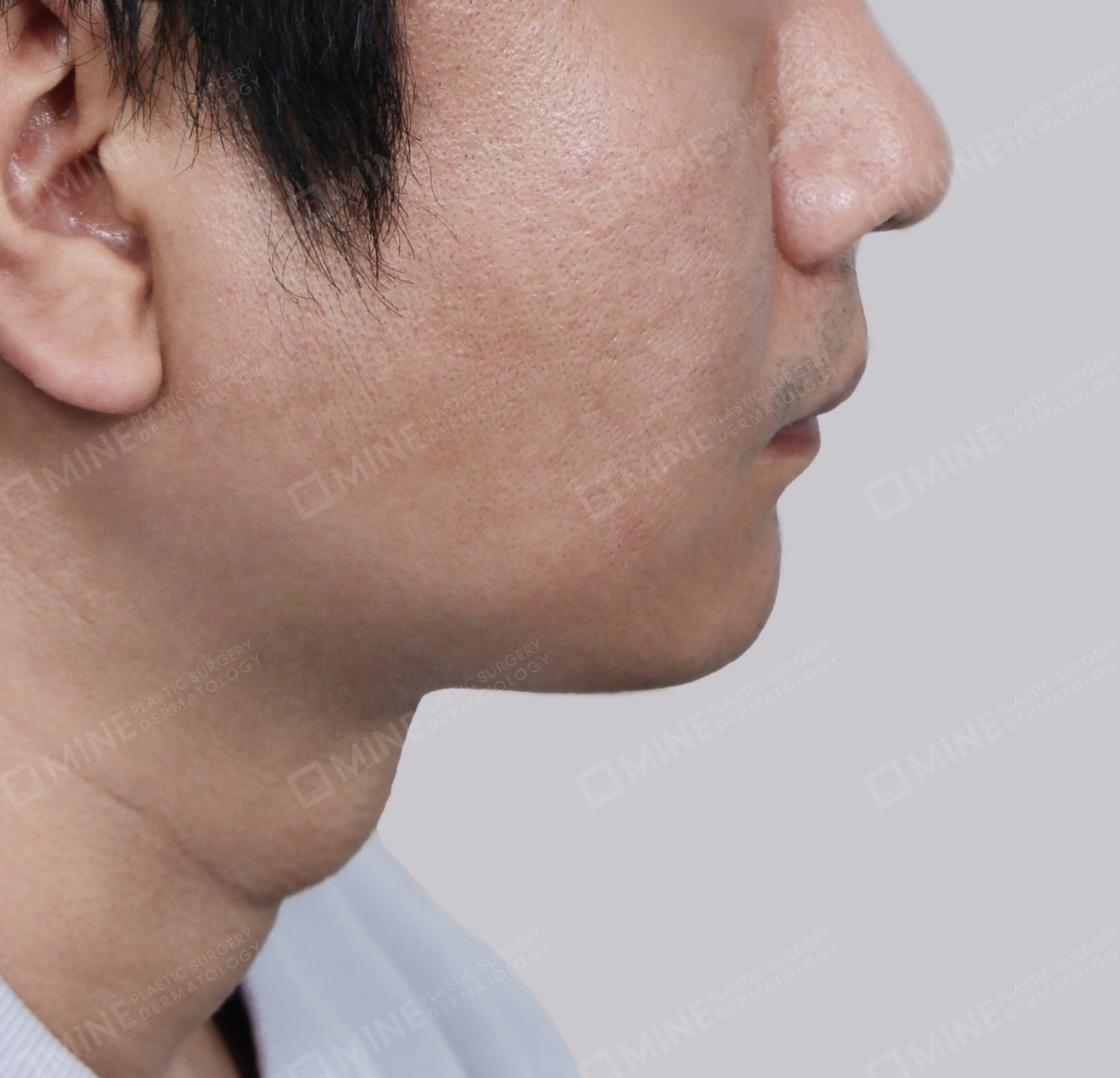 Mini Neck Lift-Side-After