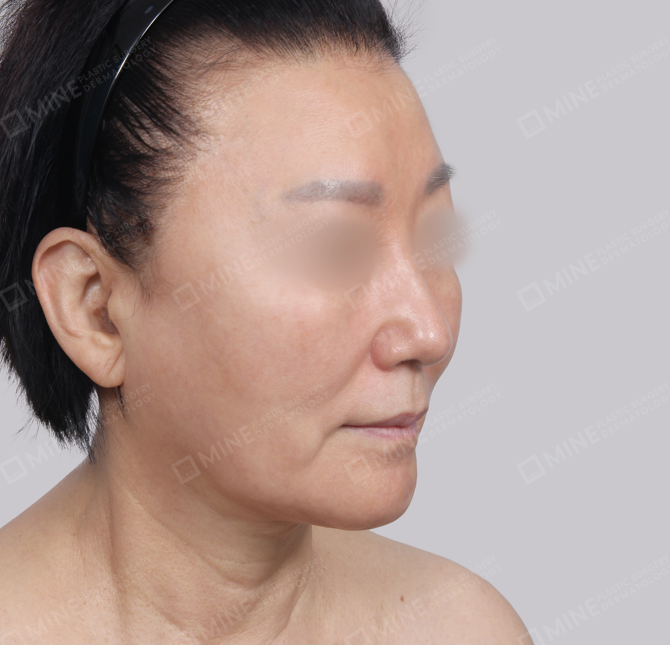 SMAS Face Lift-45-Degree-Before