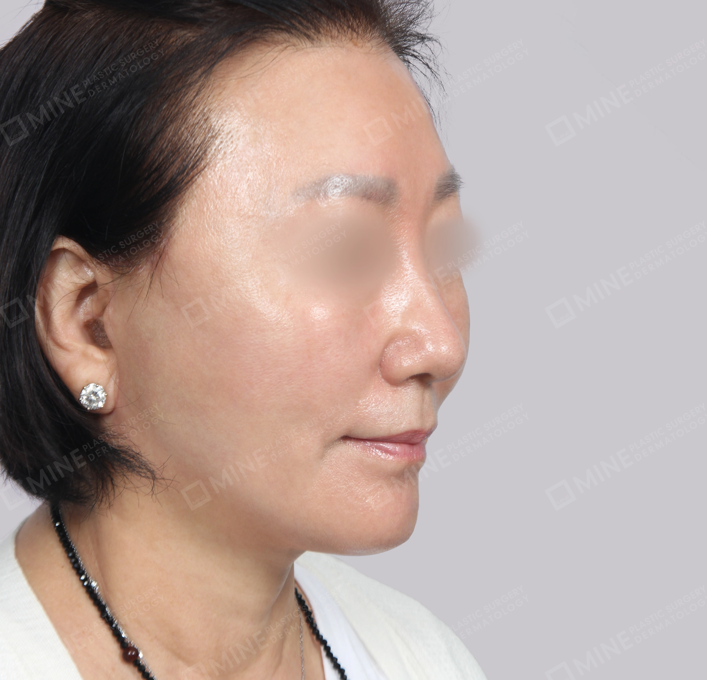 SMAS Face Lift-45-Degree-After