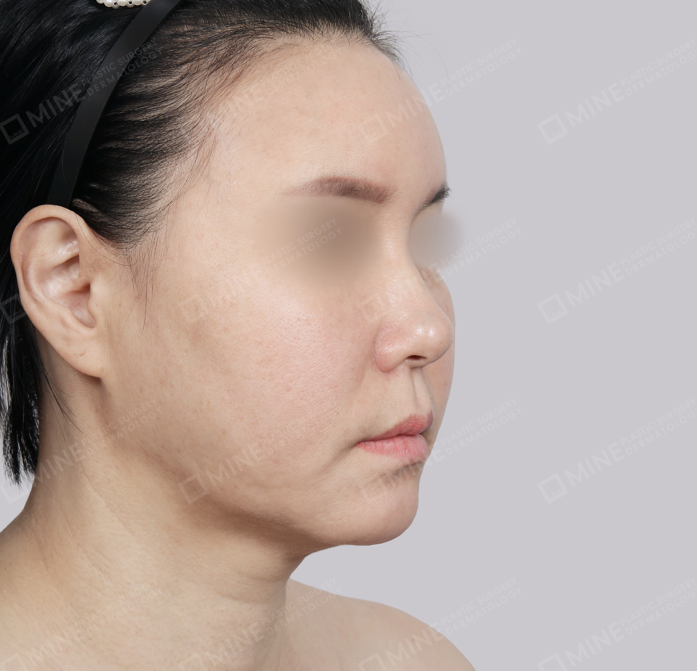 SMAS Face Lift-45-Degree-Before