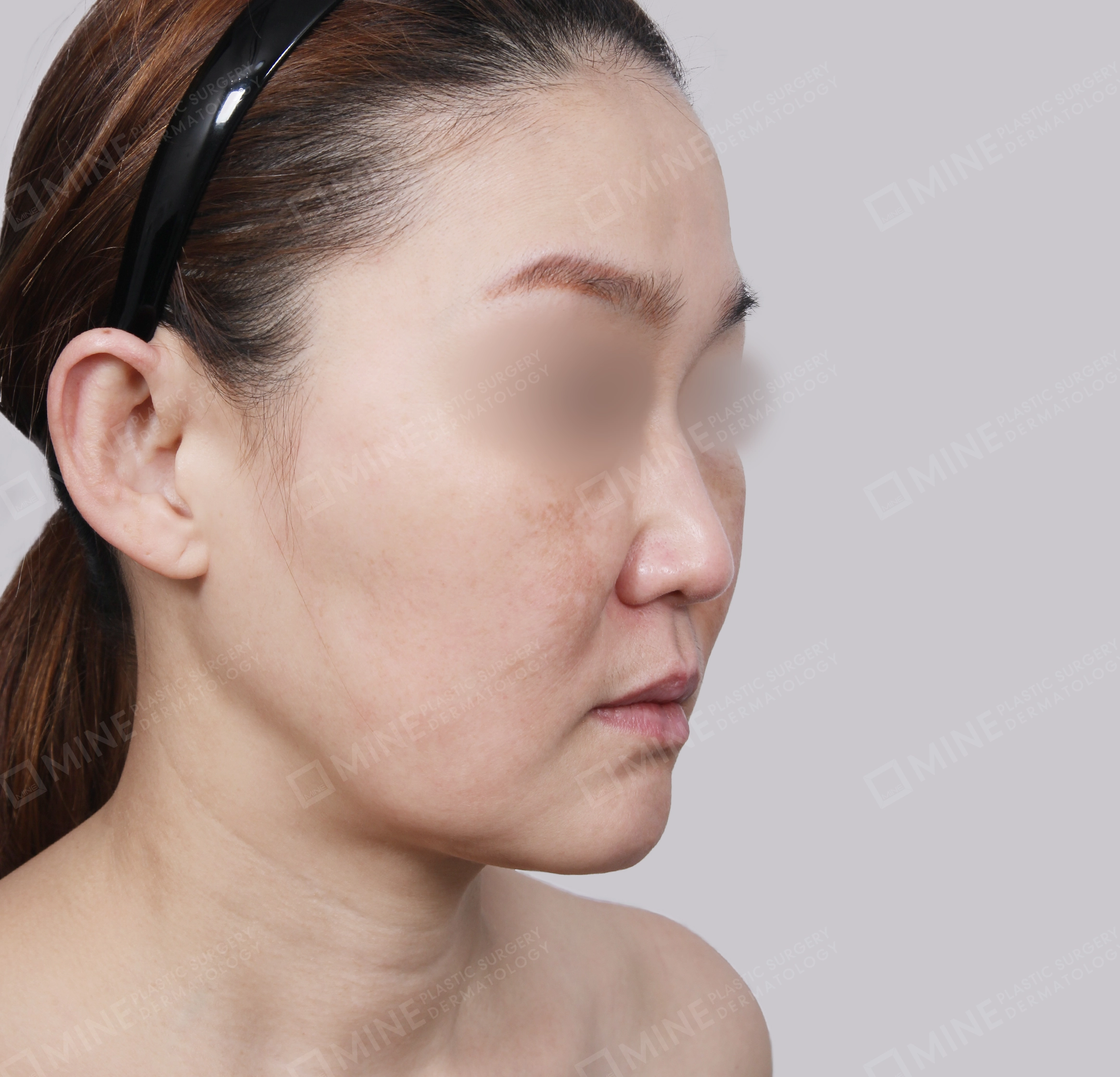 SMAS Face Lift-45-Degree-Before