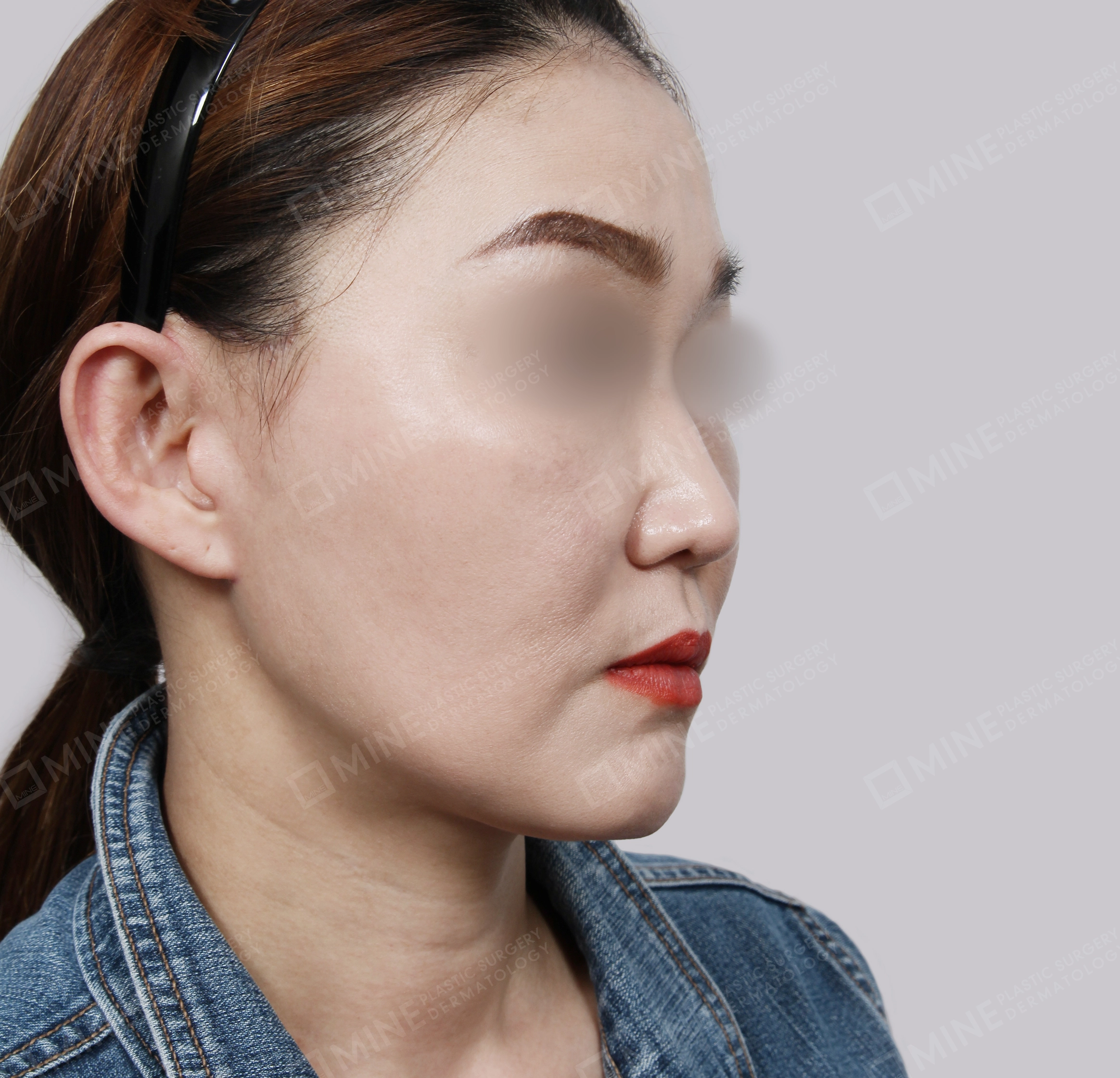 SMAS Face Lift-45-Degree-After
