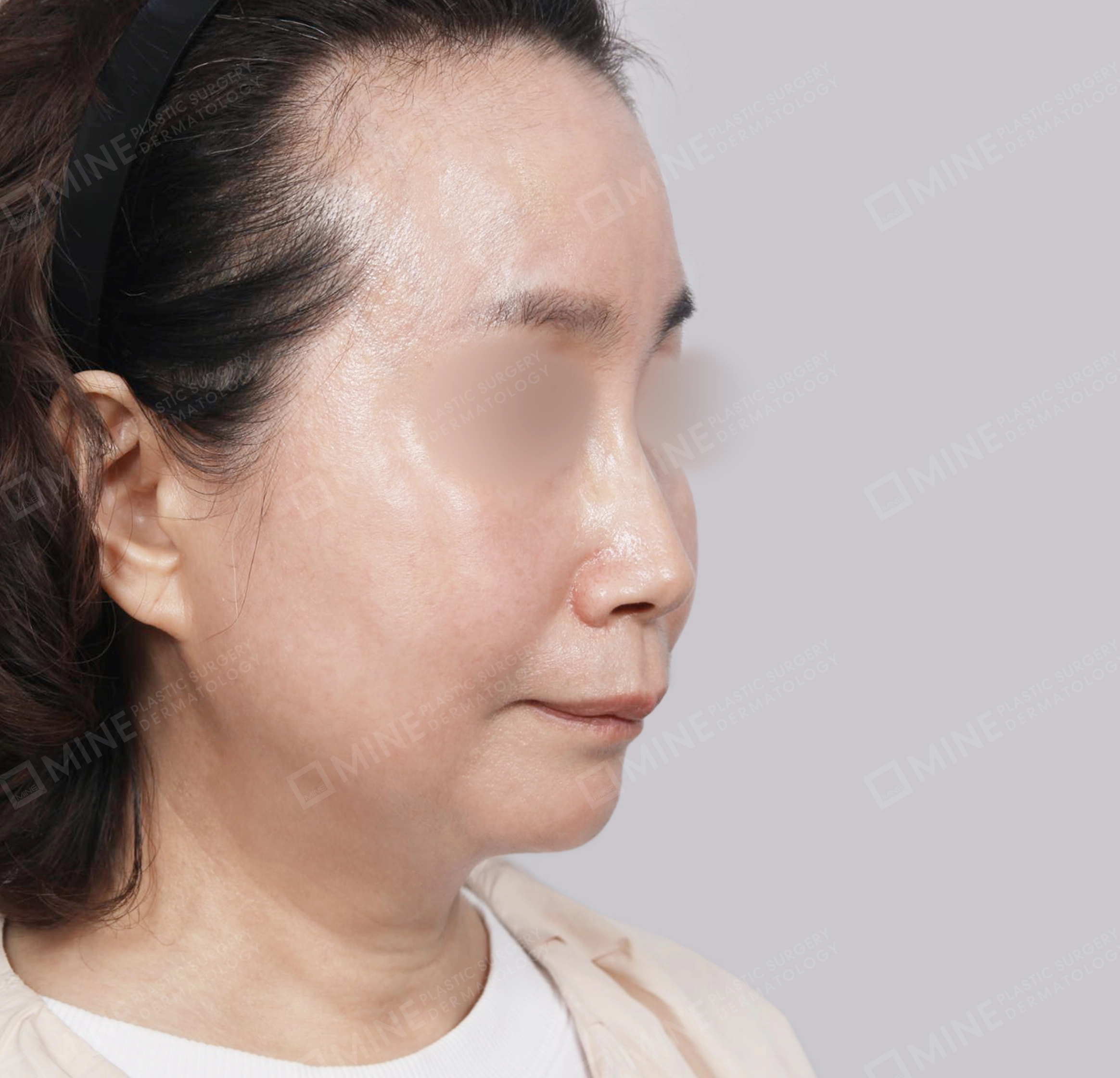 SMAS Face Lift-45-Degree-After