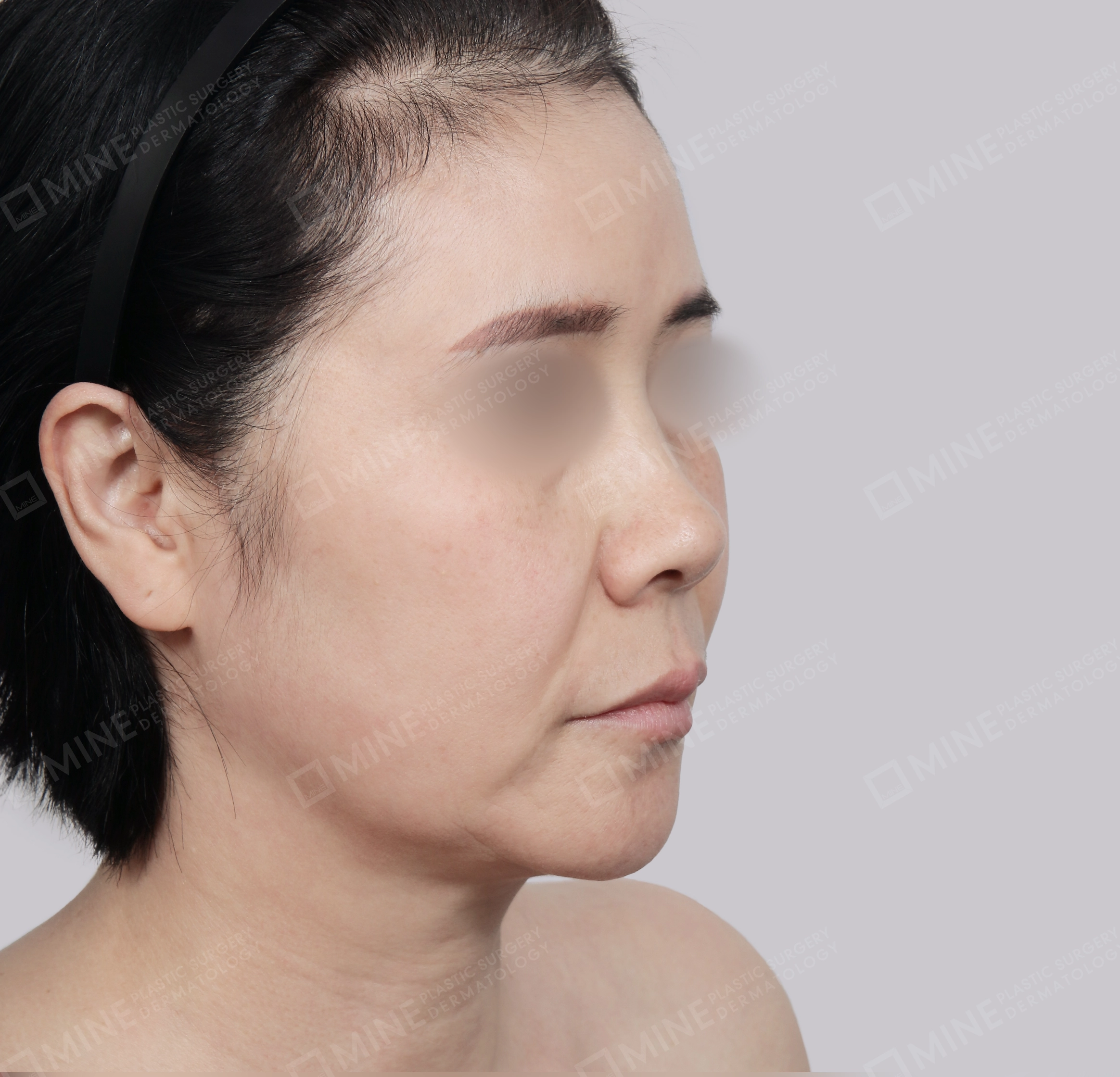 SMAS Face Lift-45-Degree-Before