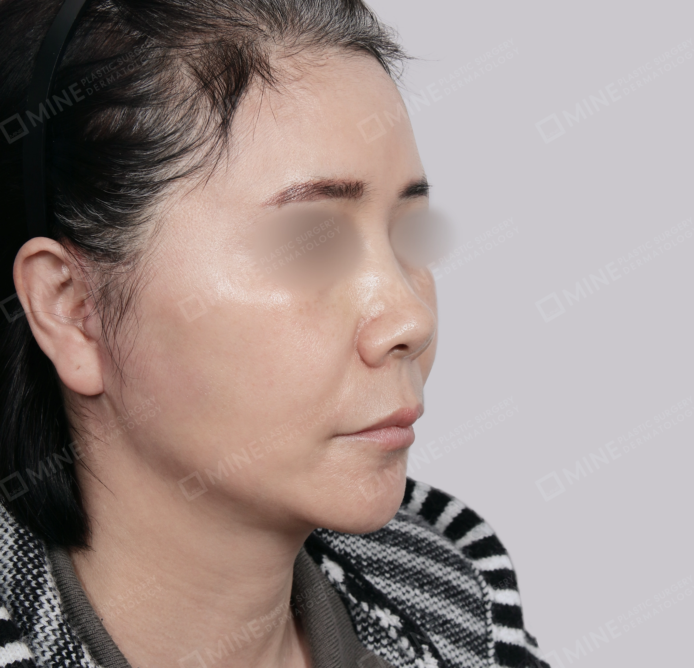 SMAS Face Lift-45-Degree-After