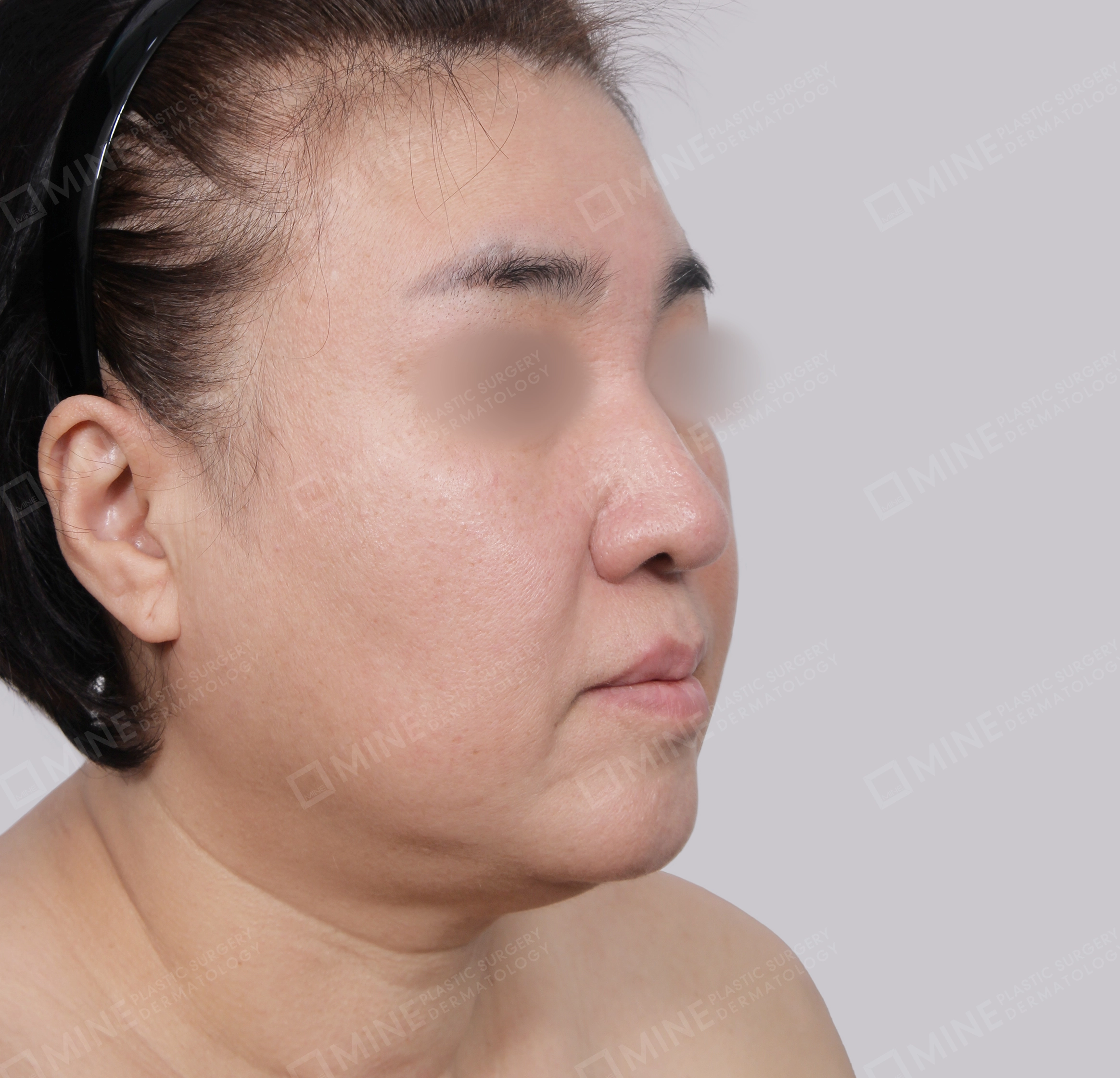 SMAS Face Lift-45-Degree-Before