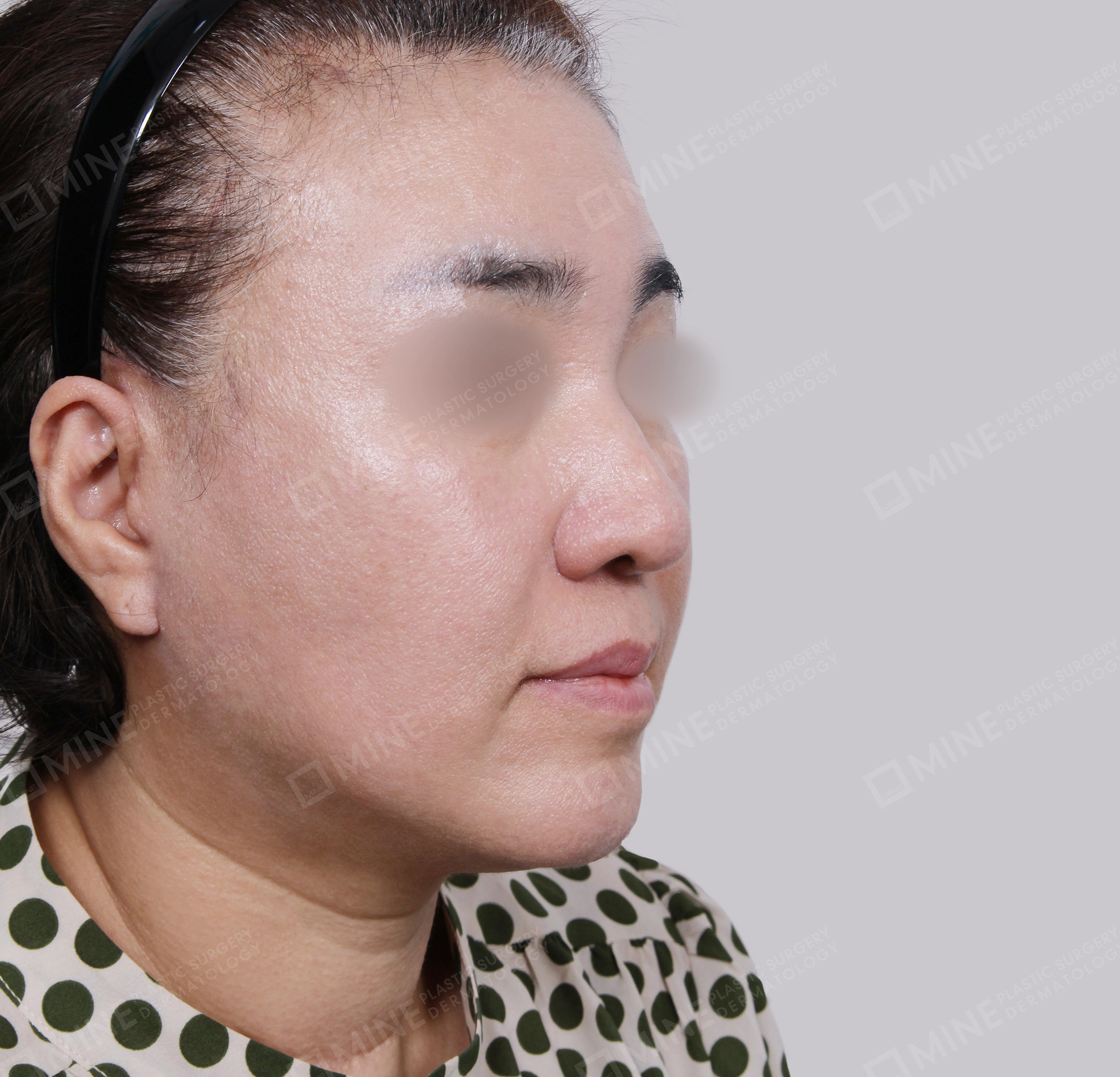SMAS Face Lift-45-Degree-After