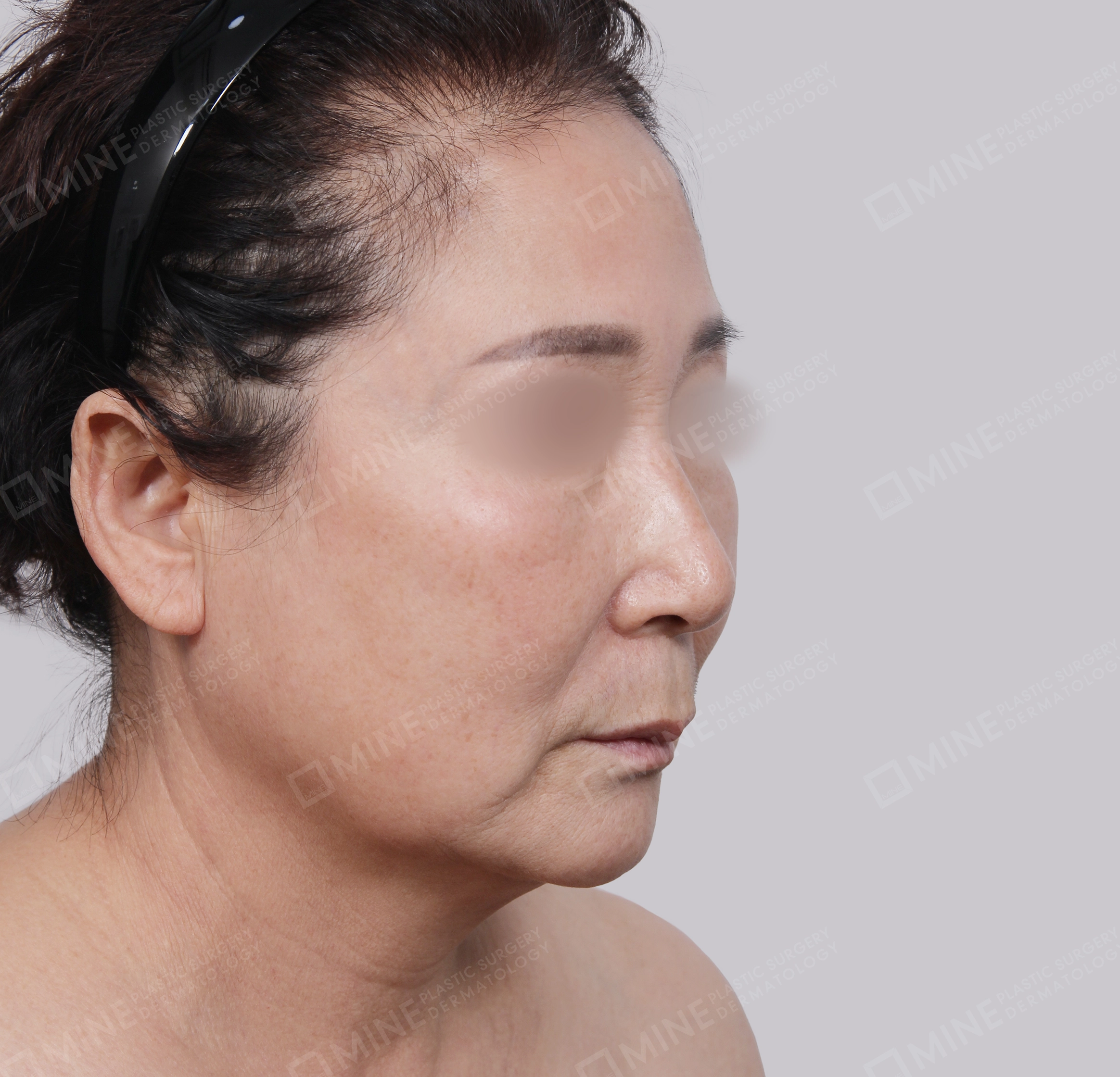 SMAS Face Lift-45-Degree-Before