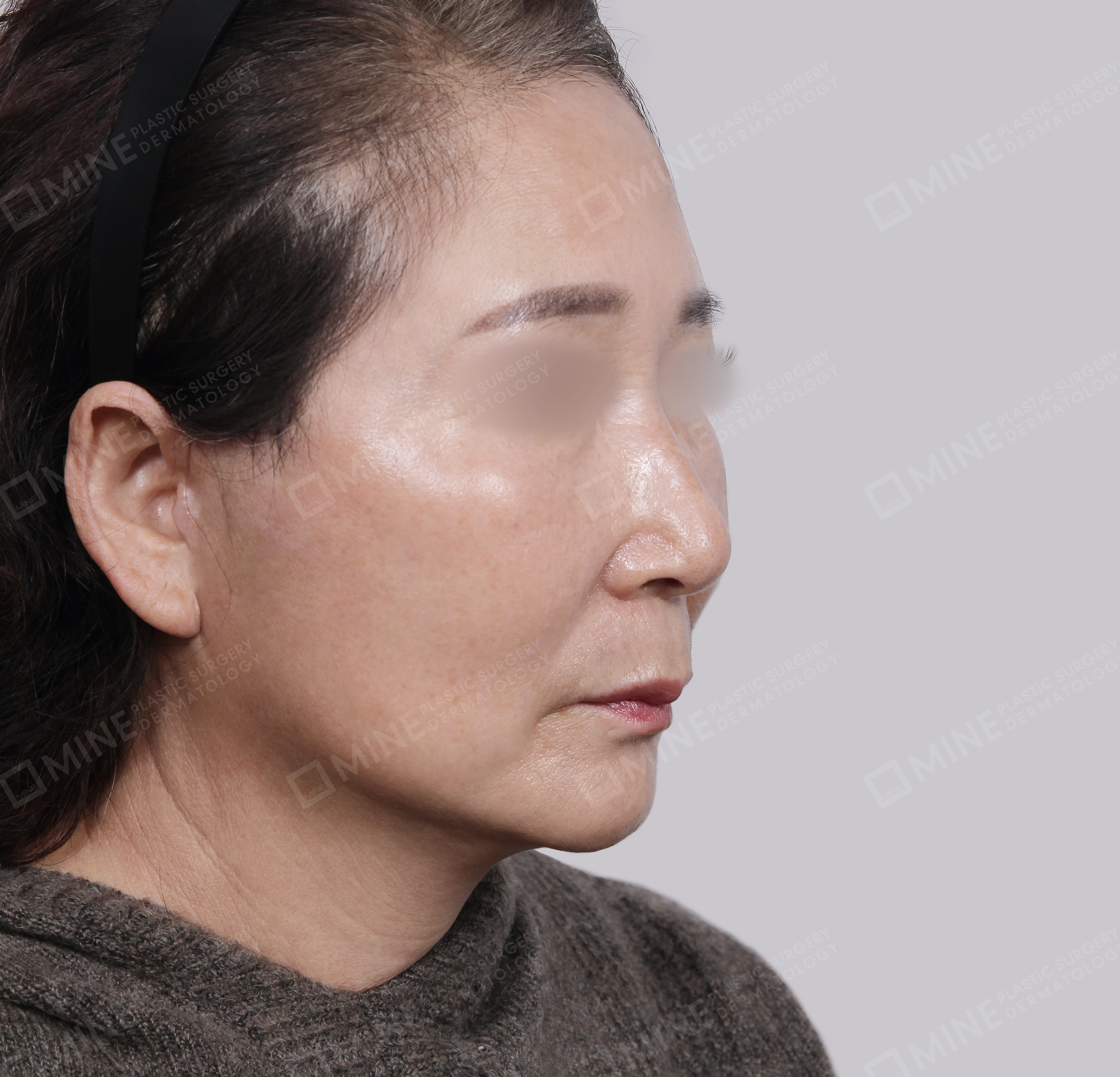 SMAS Face Lift-45-Degree-After