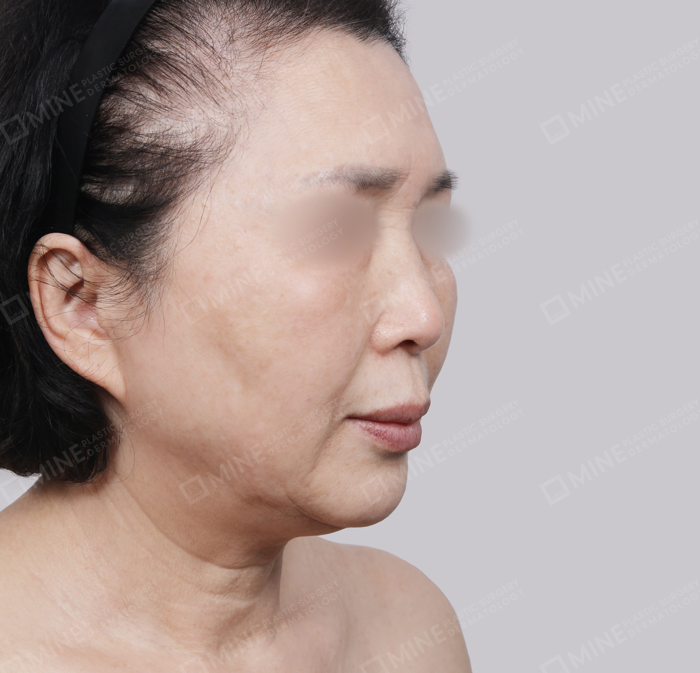SMAS Face Lift-45-Degree-Before