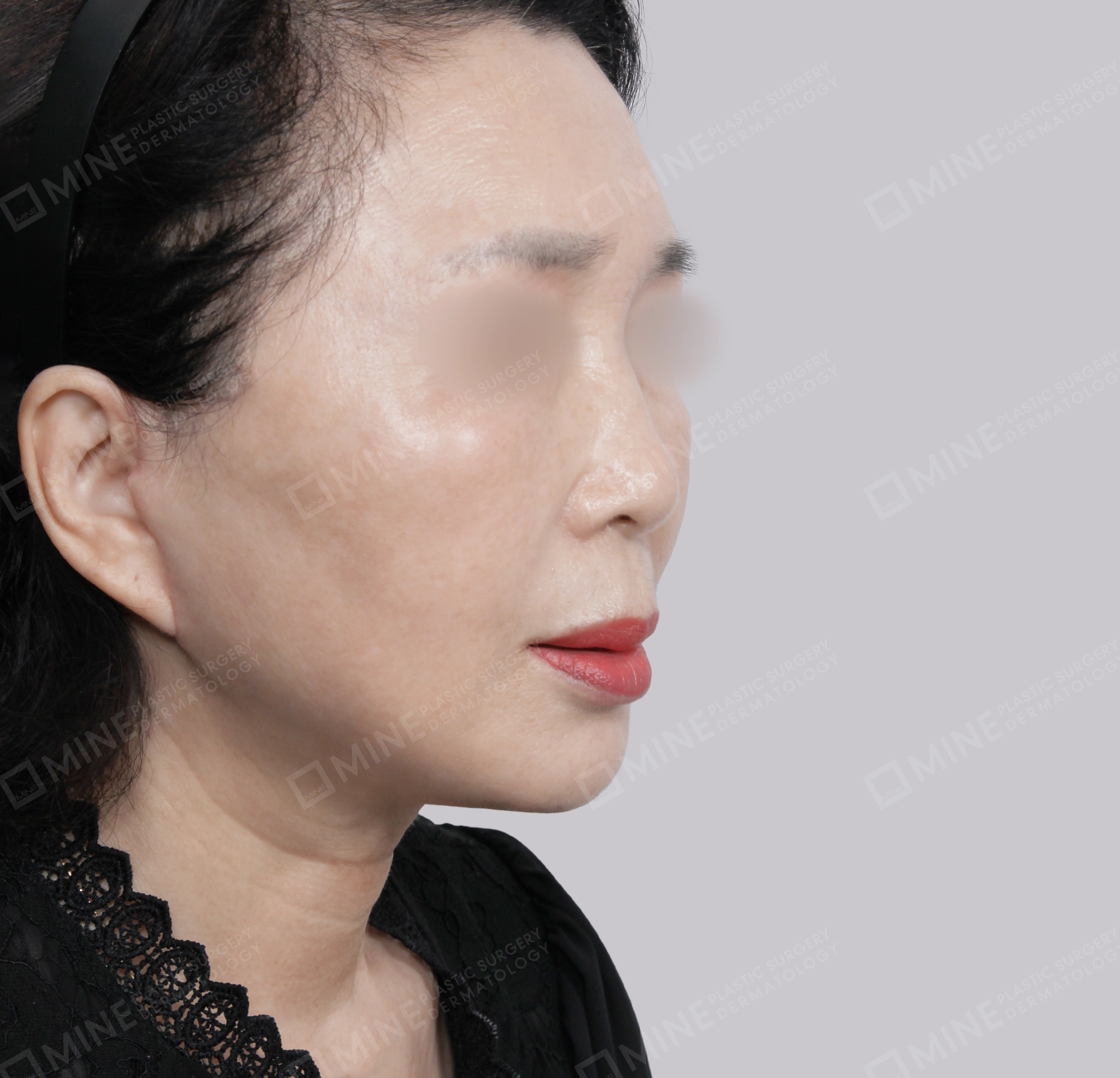 SMAS Face Lift-45-Degree-After