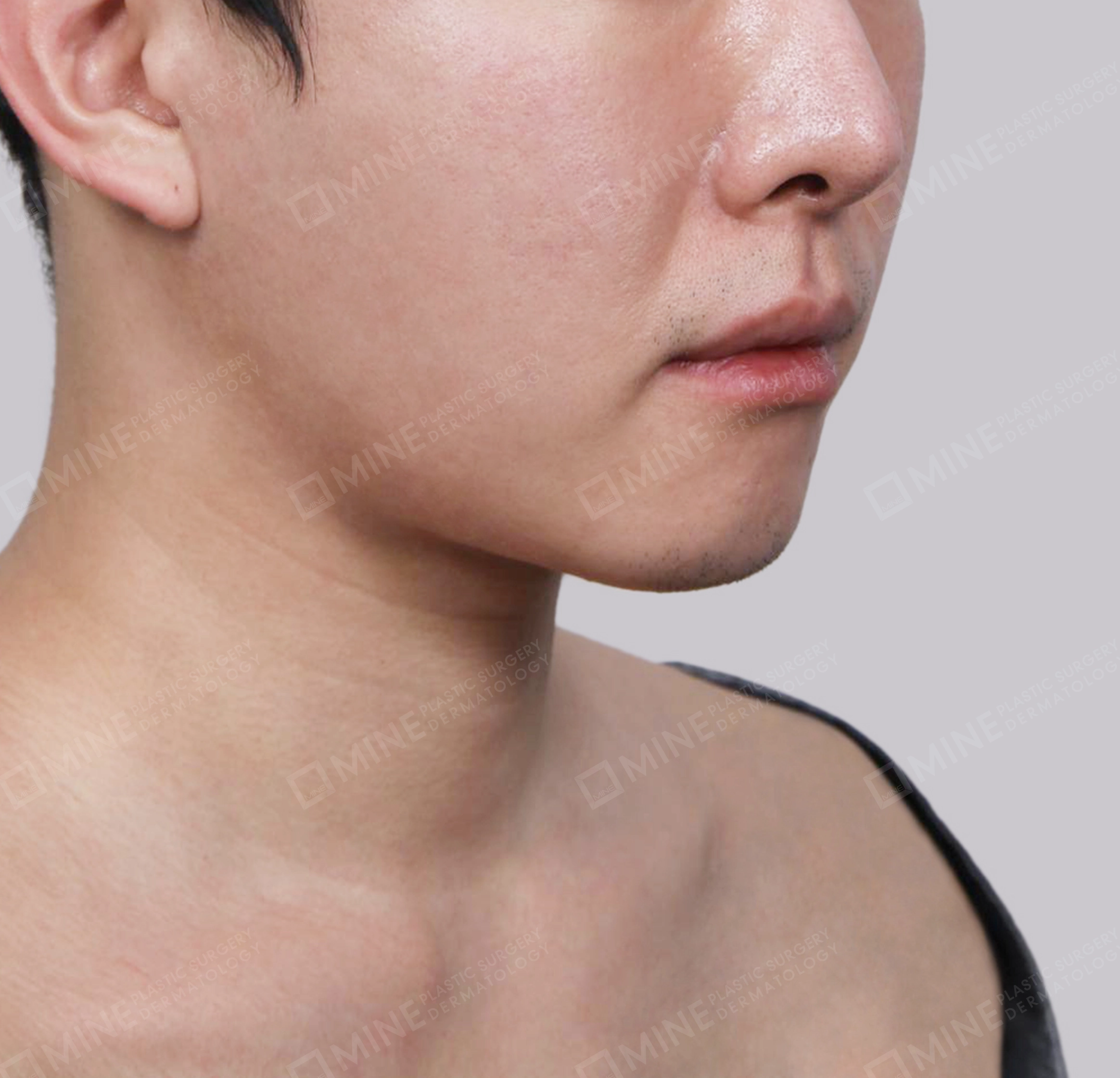 Double Chin (Vlimming)-Front-Before