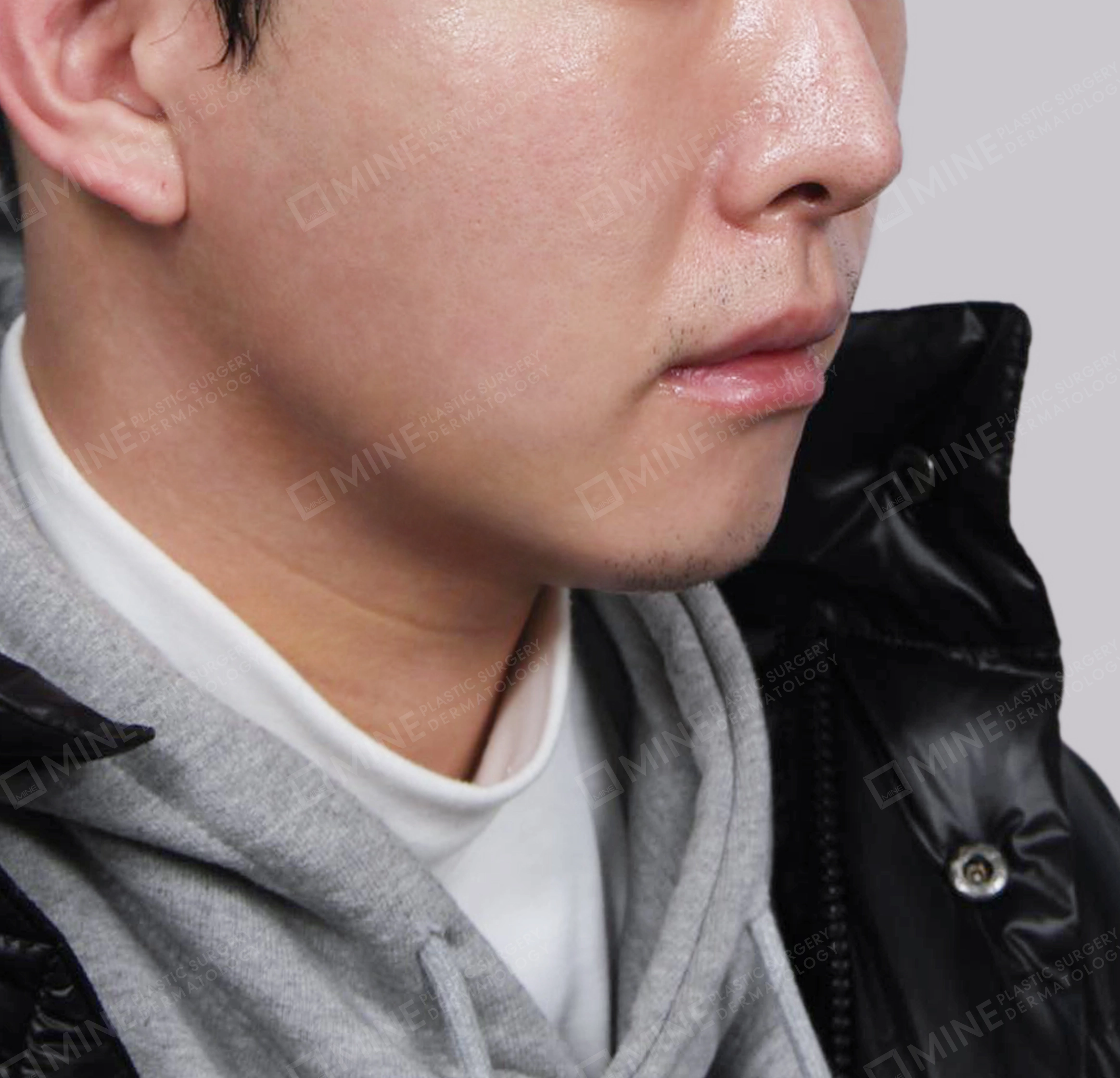 Double Chin (Vlimming)-Front-After