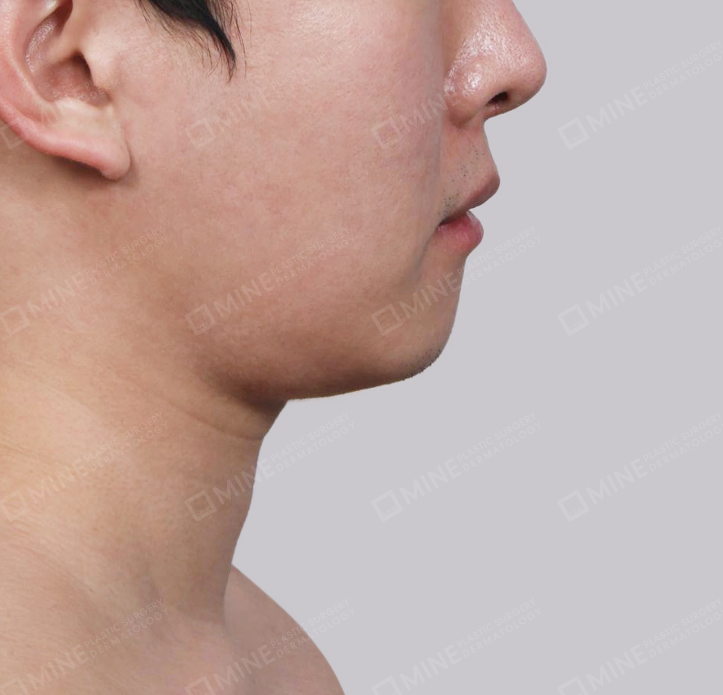 Double Chin (Vlimming)-Side-Before