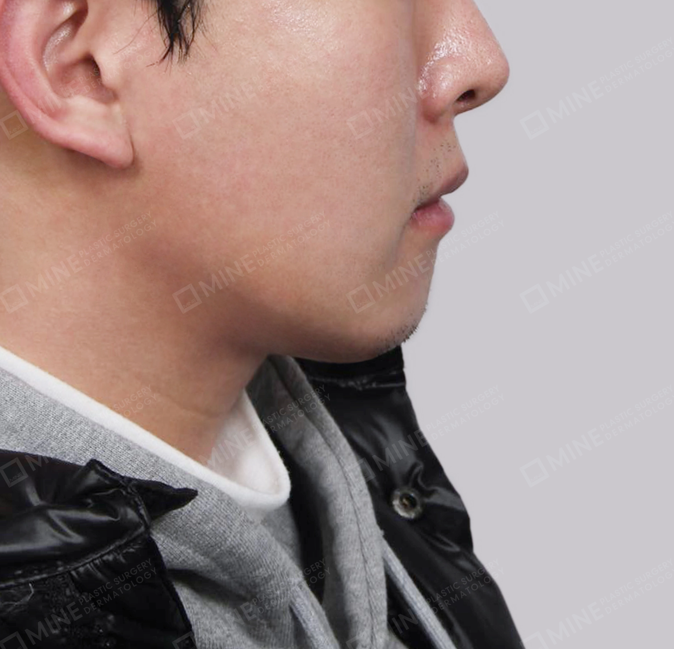 Double Chin (Vlimming)-Side-After