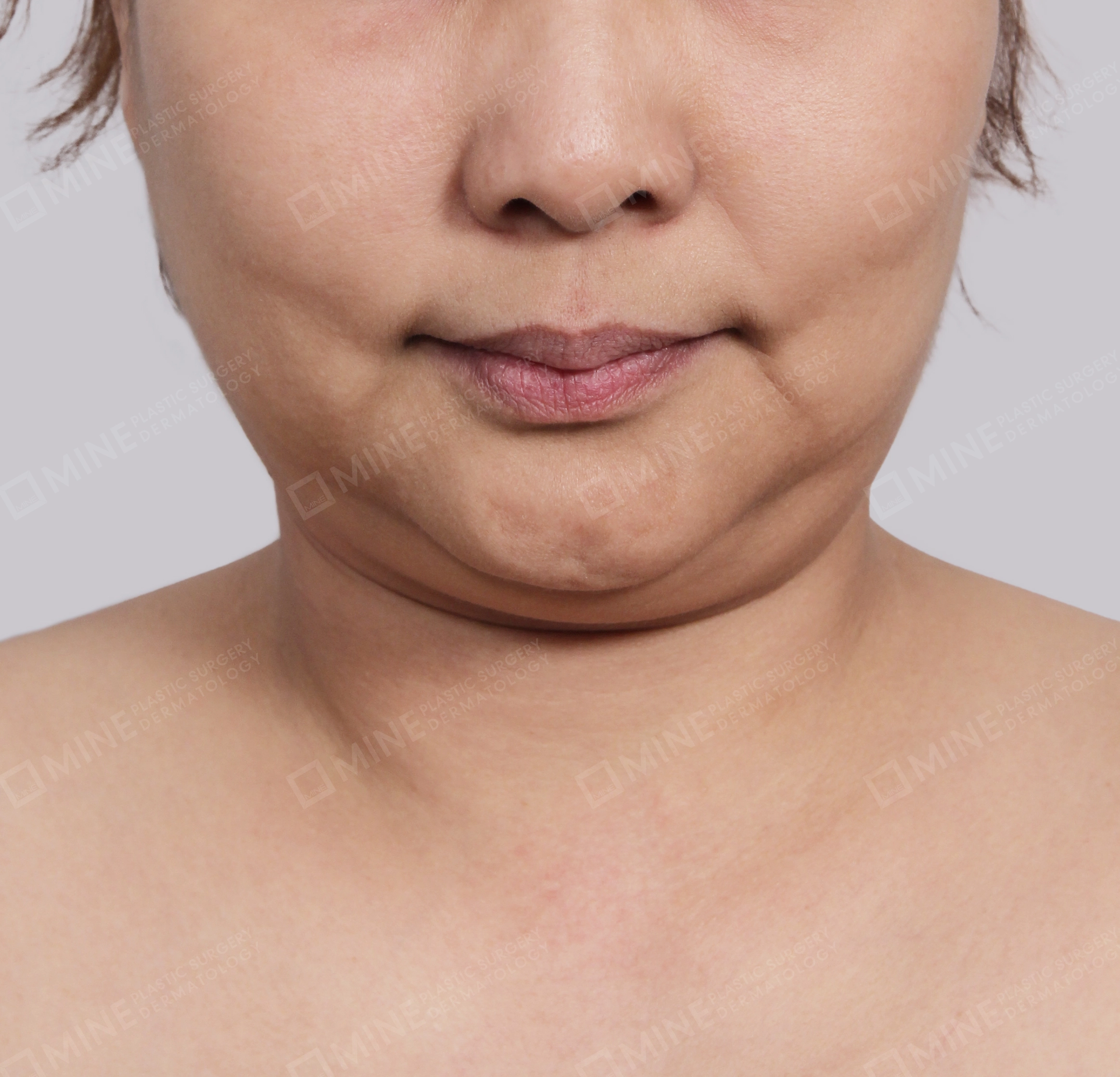 Double Chin (Vlimming)-Front-Before
