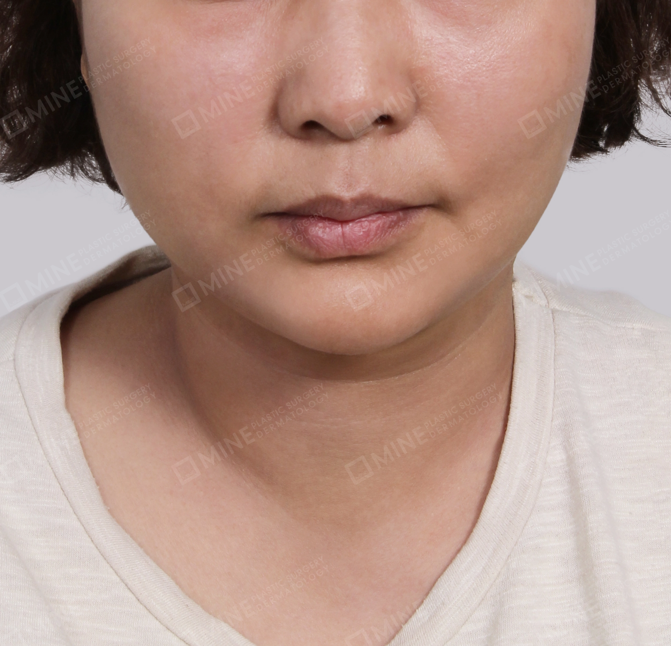 Double Chin (Vlimming)-Front-After
