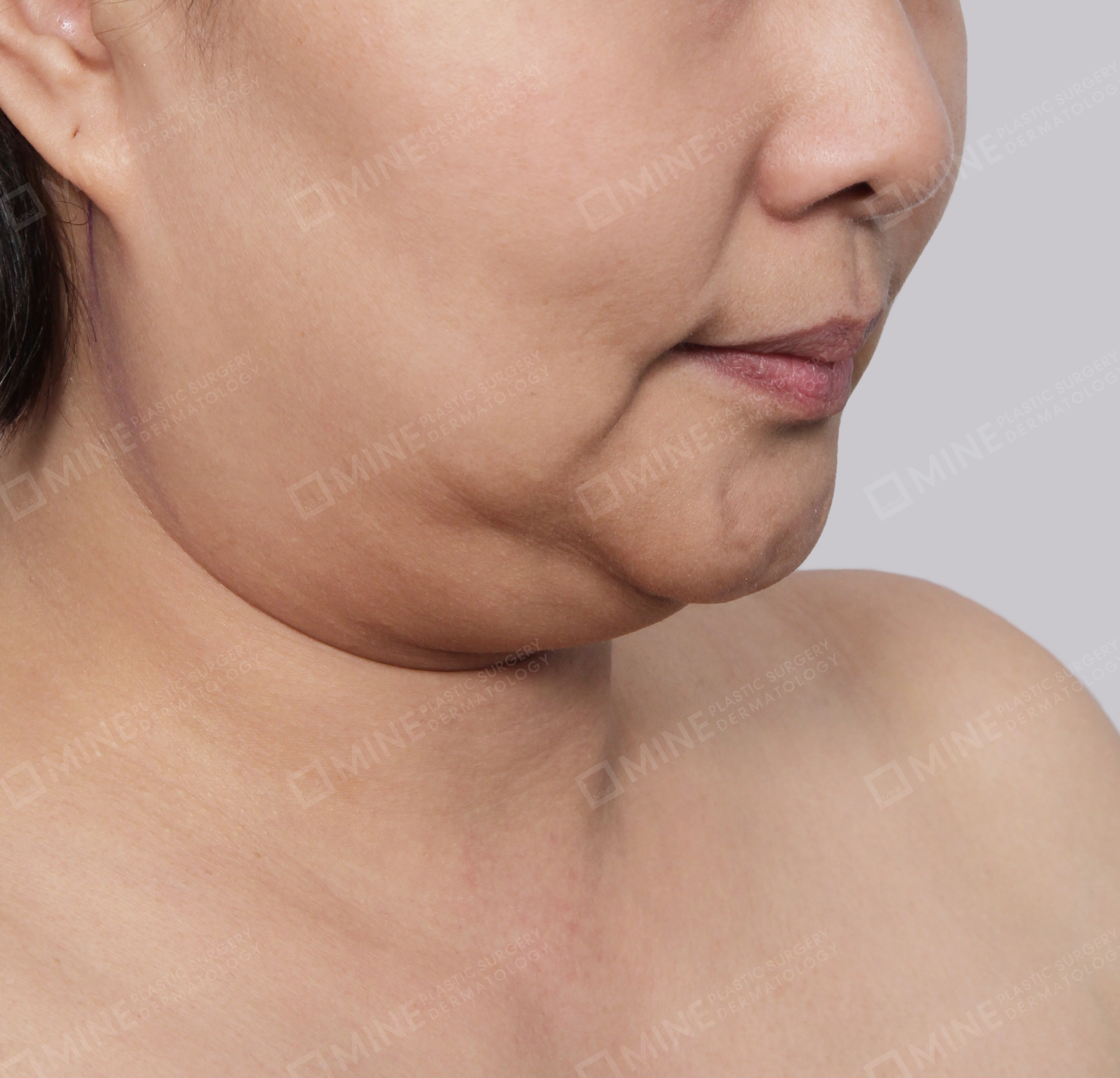 Double Chin (Vlimming)-45-Degree-Before