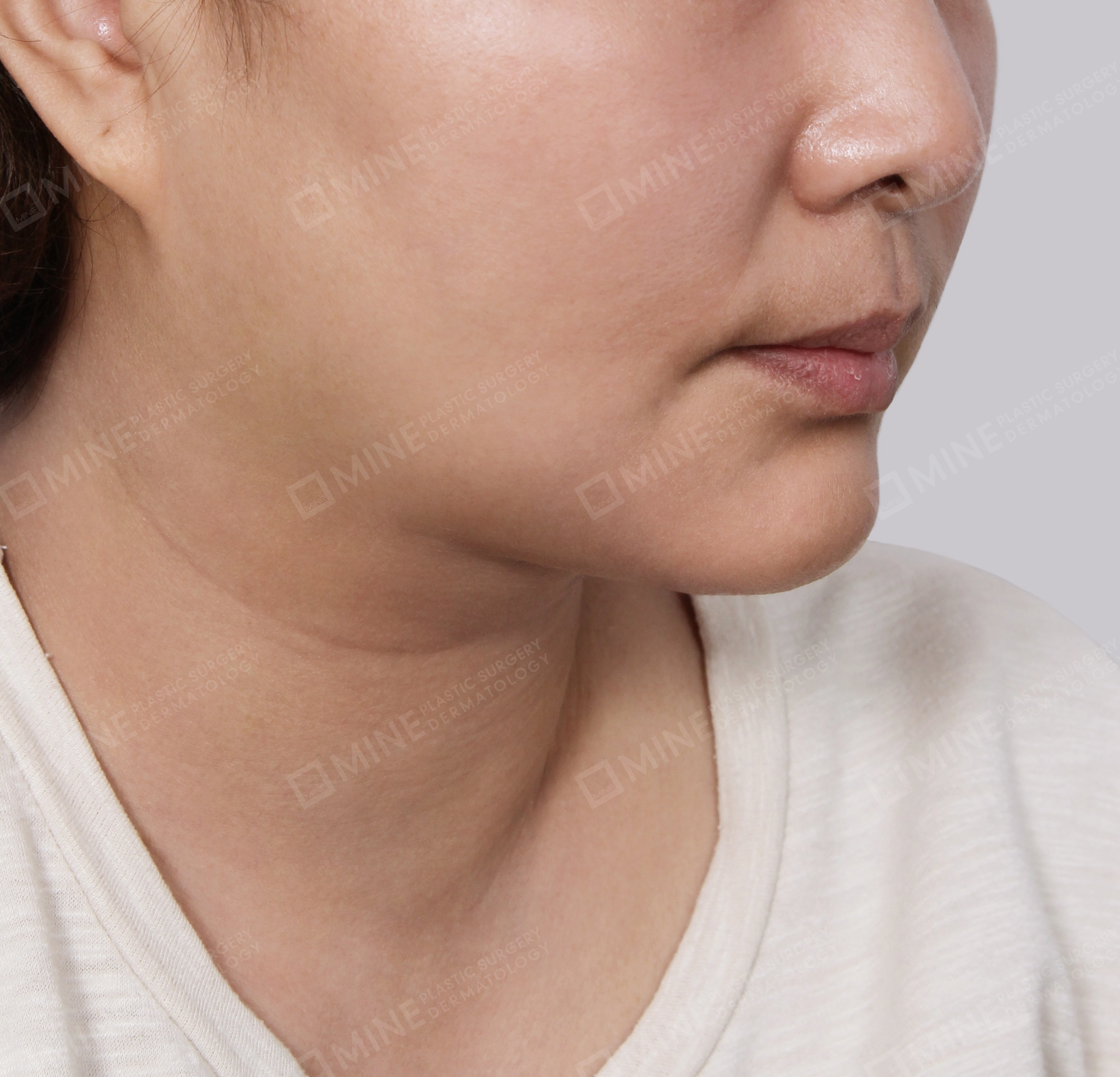 Double Chin (Vlimming)-45-Degree-After