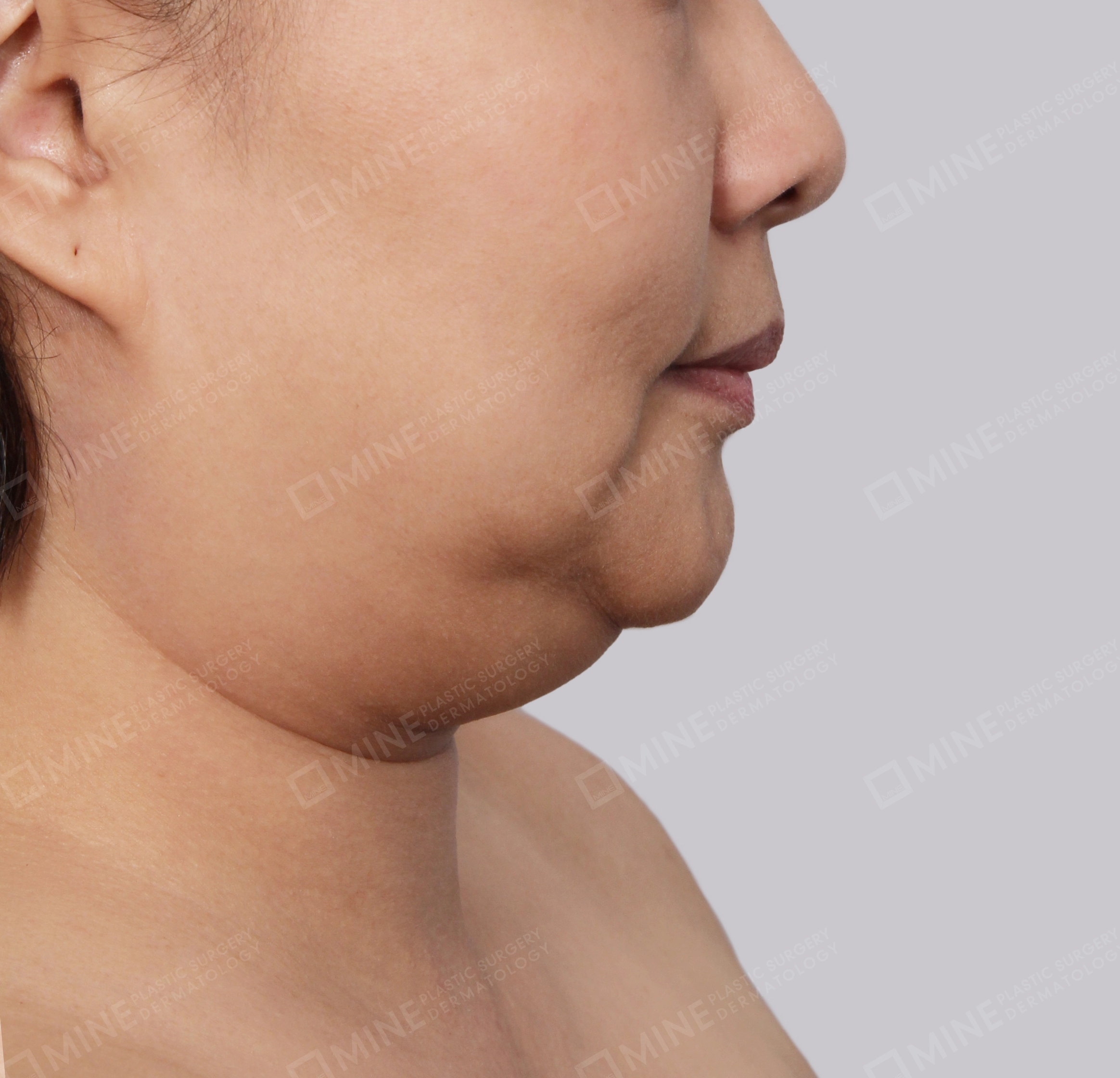 Double Chin (Vlimming)-Side-Before