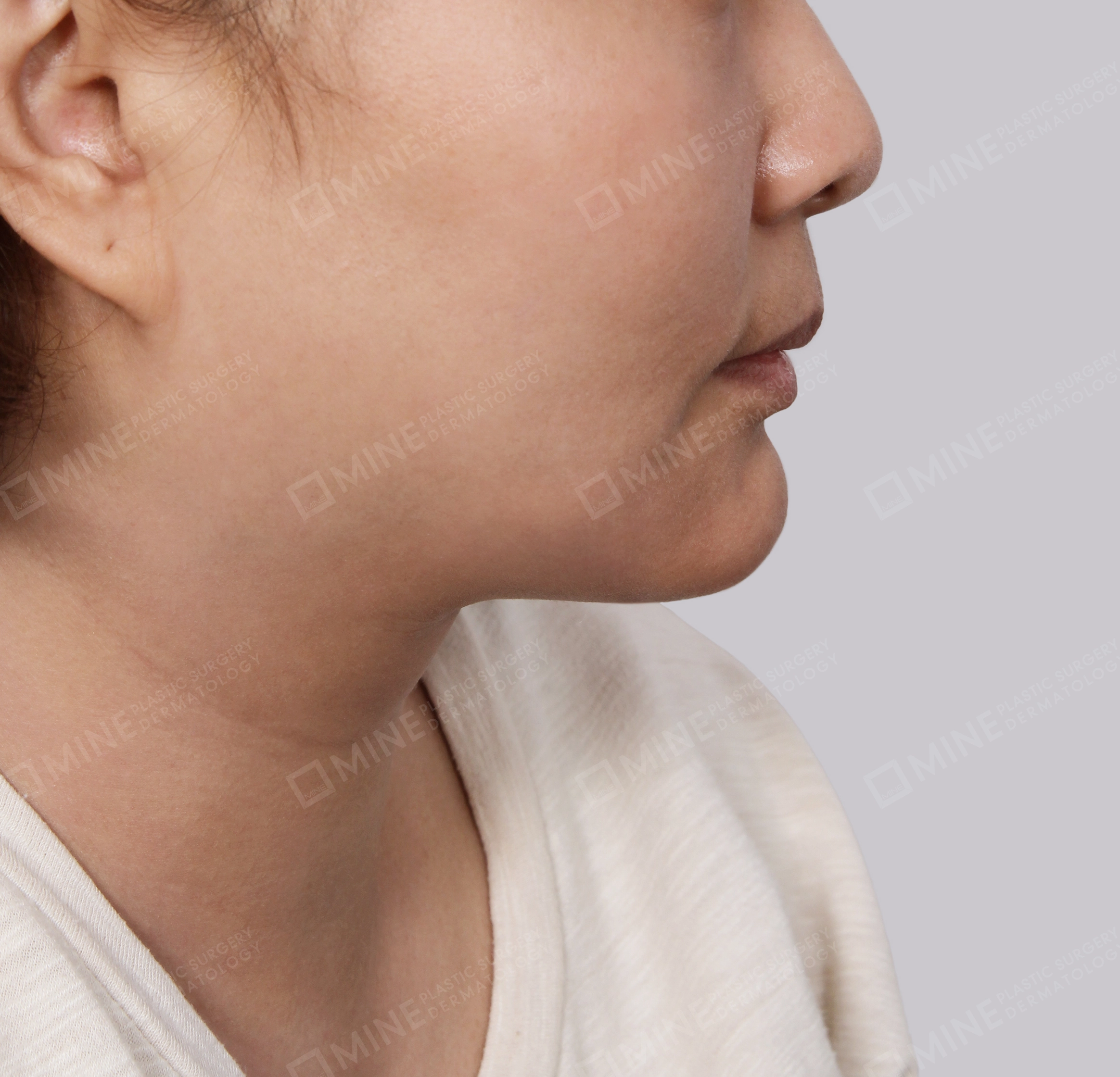 Double Chin (Vlimming)-Side-After