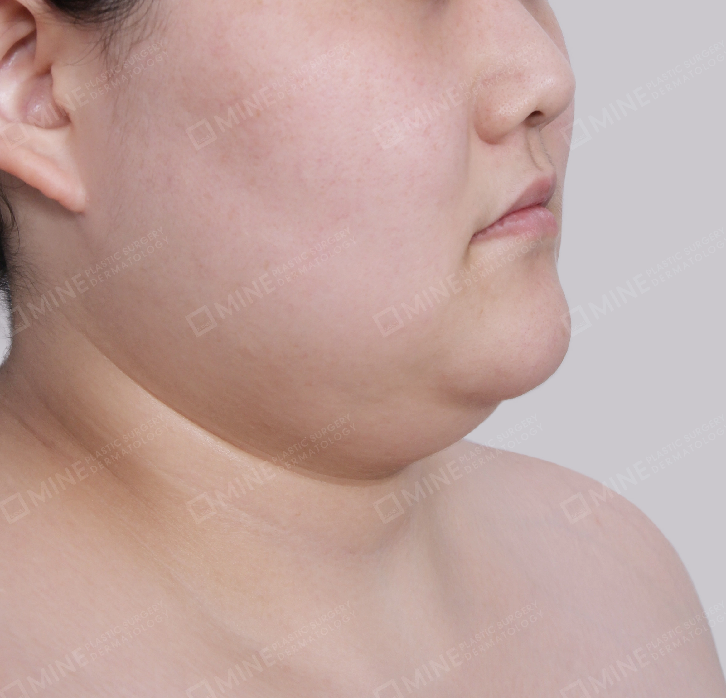 Double Chin (Vlimming)-Front-Before