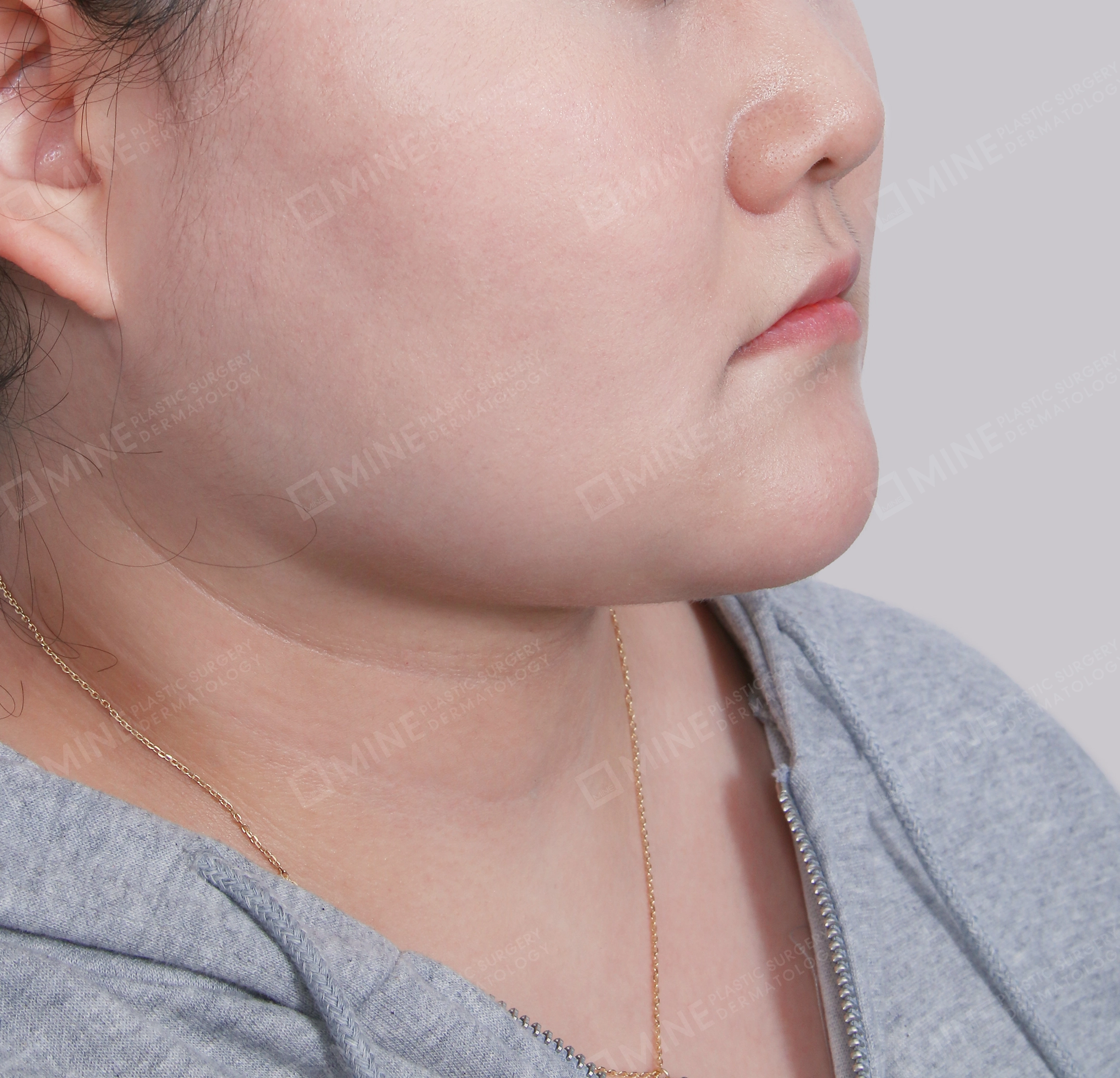 Double Chin (Vlimming)-Front-After