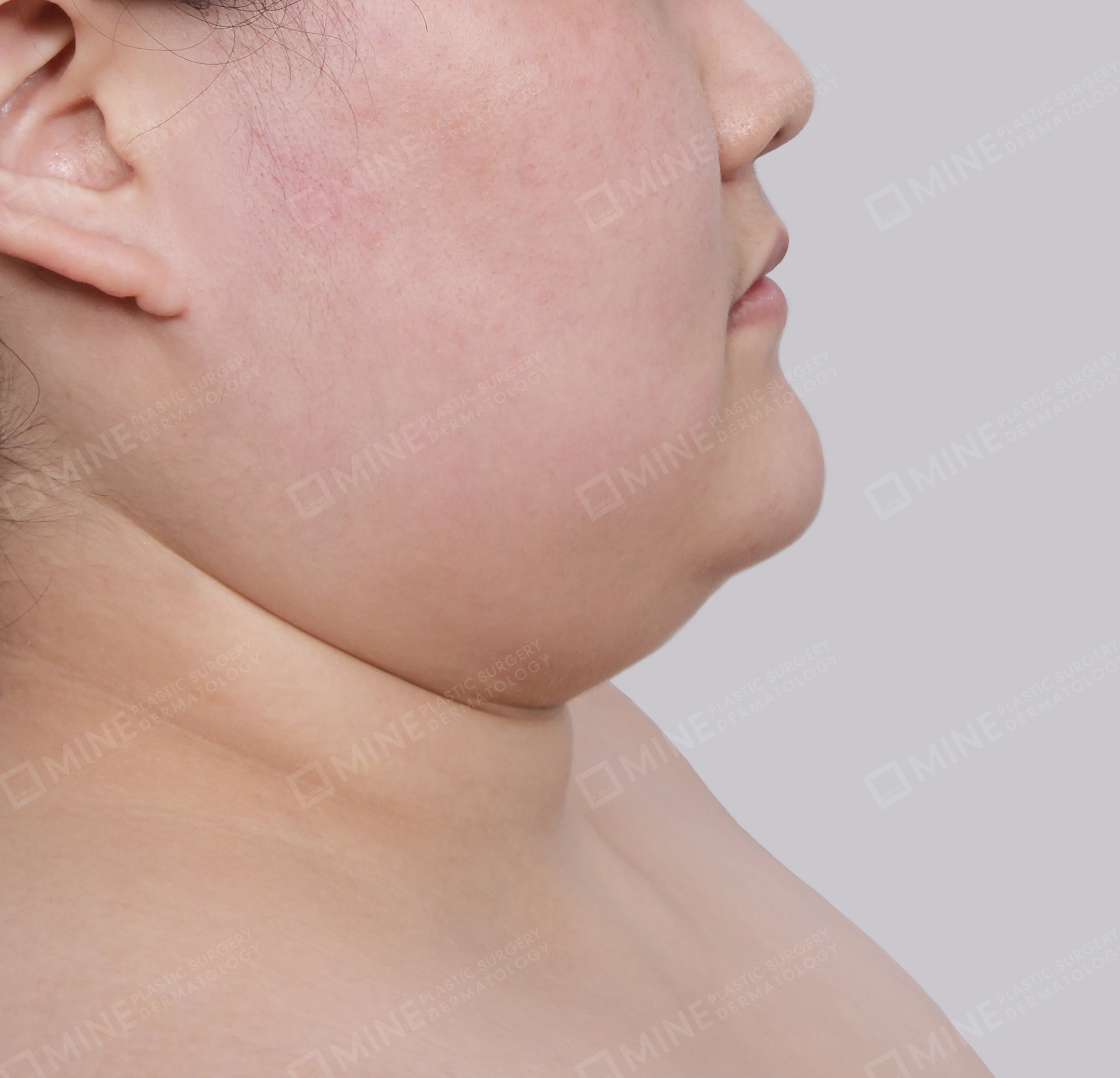 Double Chin (Vlimming)-Side-Before