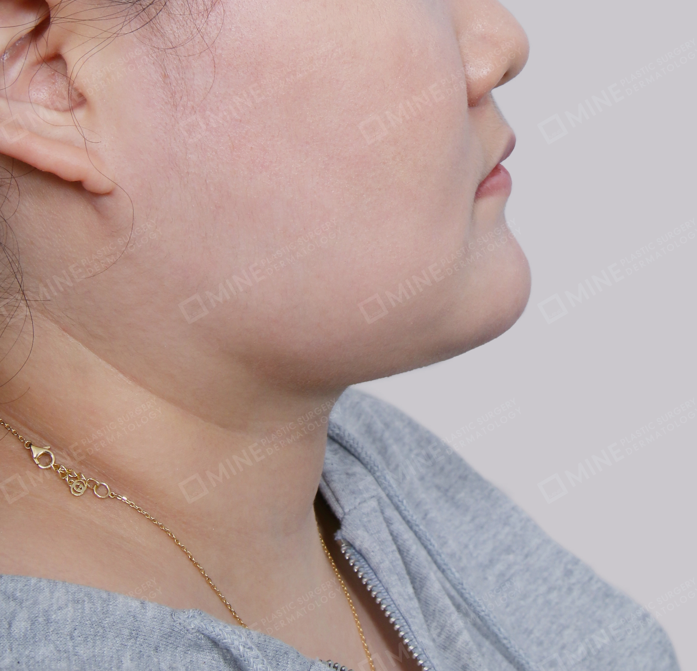 Double Chin (Vlimming)-Side-After