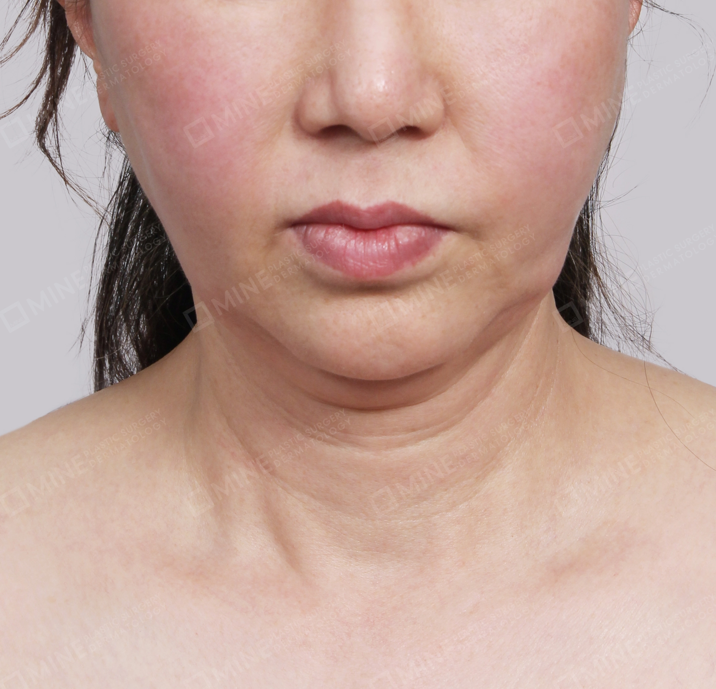 Double Chin (Vlimming)-Front-Before