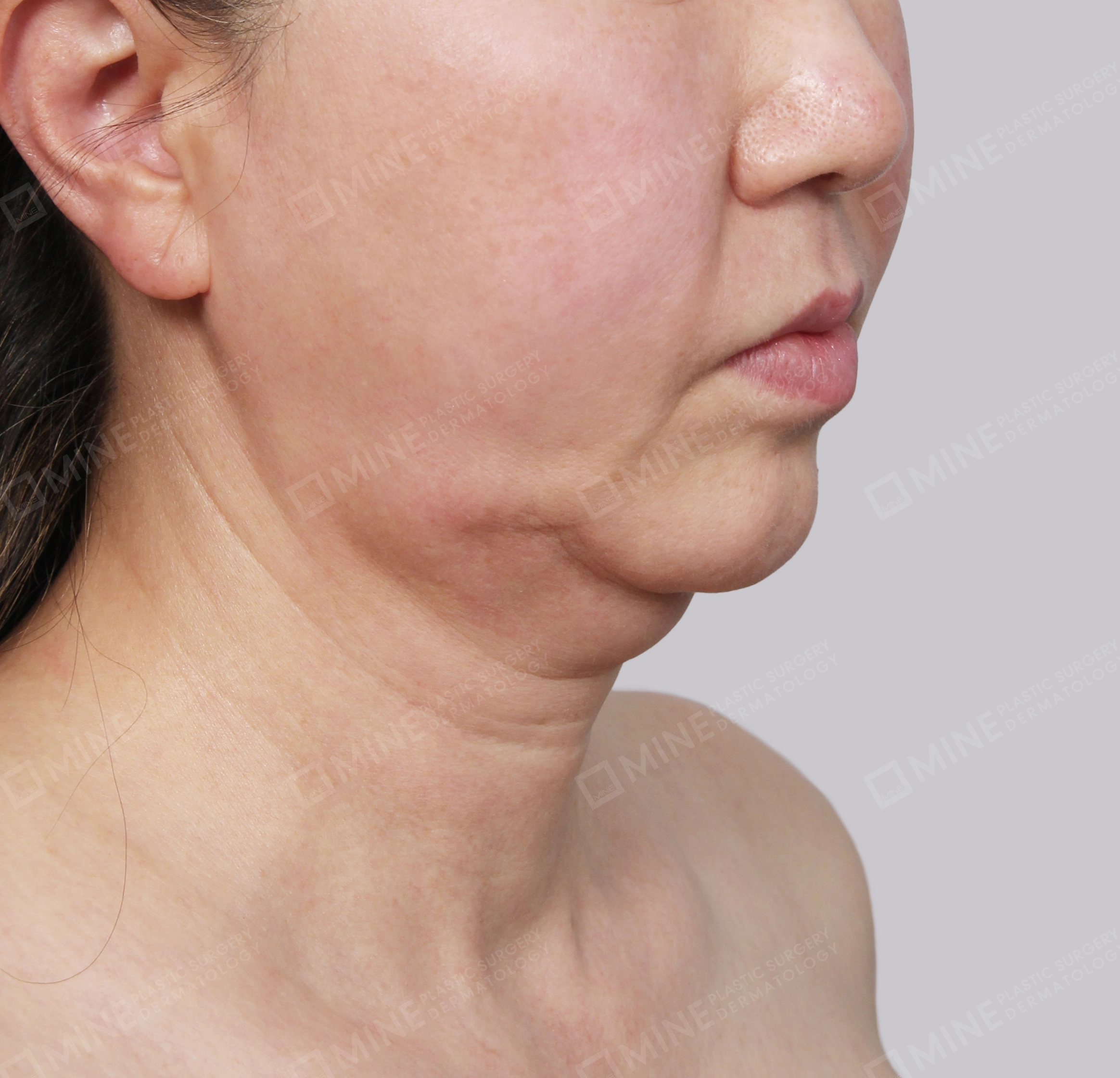 Double Chin (Vlimming)-45-Degree-Before