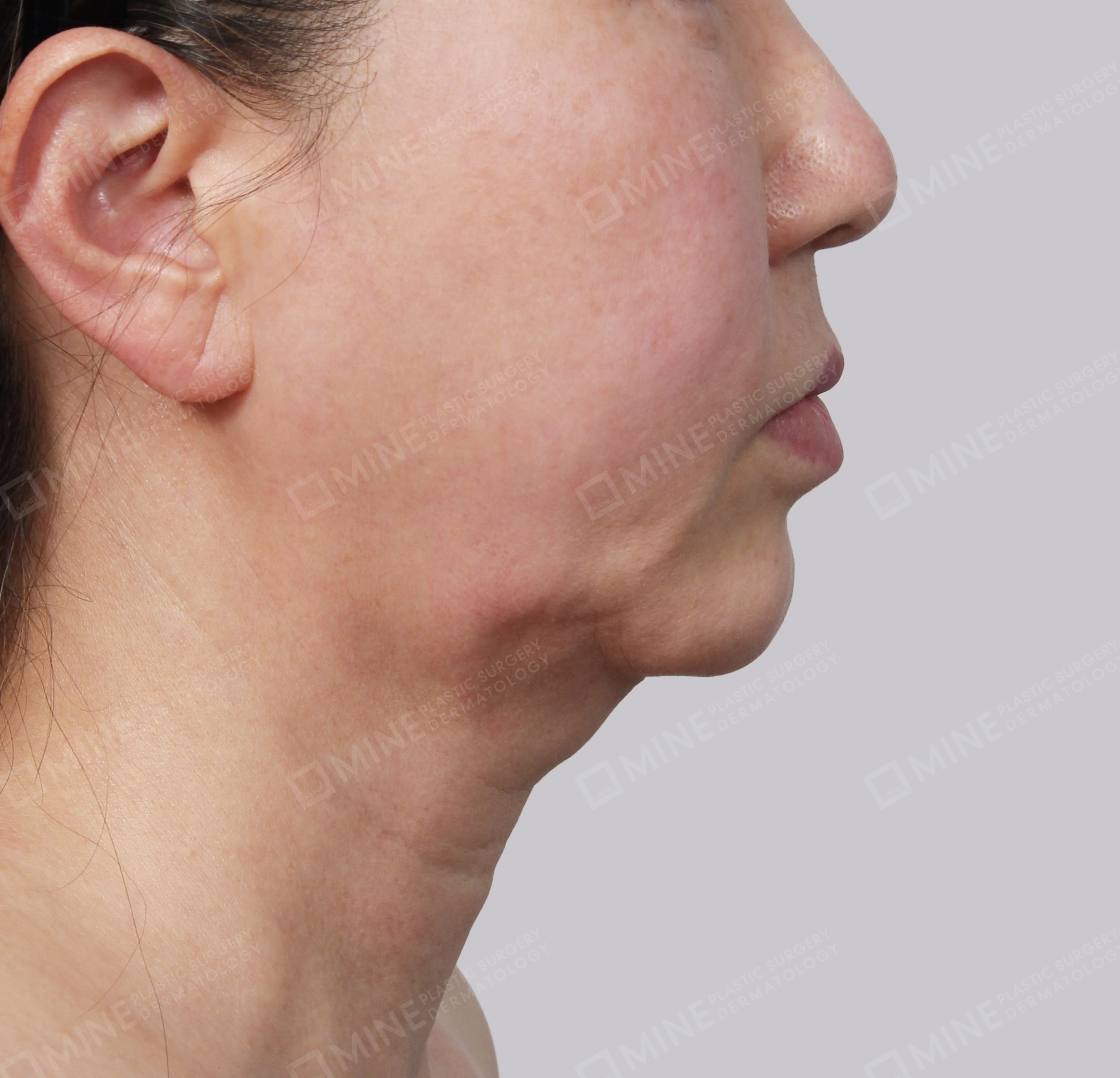 Double Chin (Vlimming)-Side-Before