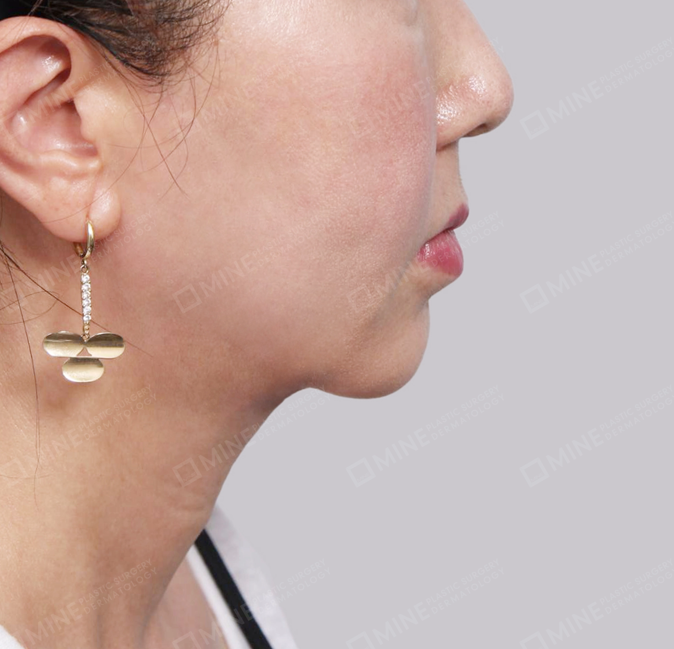 Double Chin (Vlimming)-Side-After