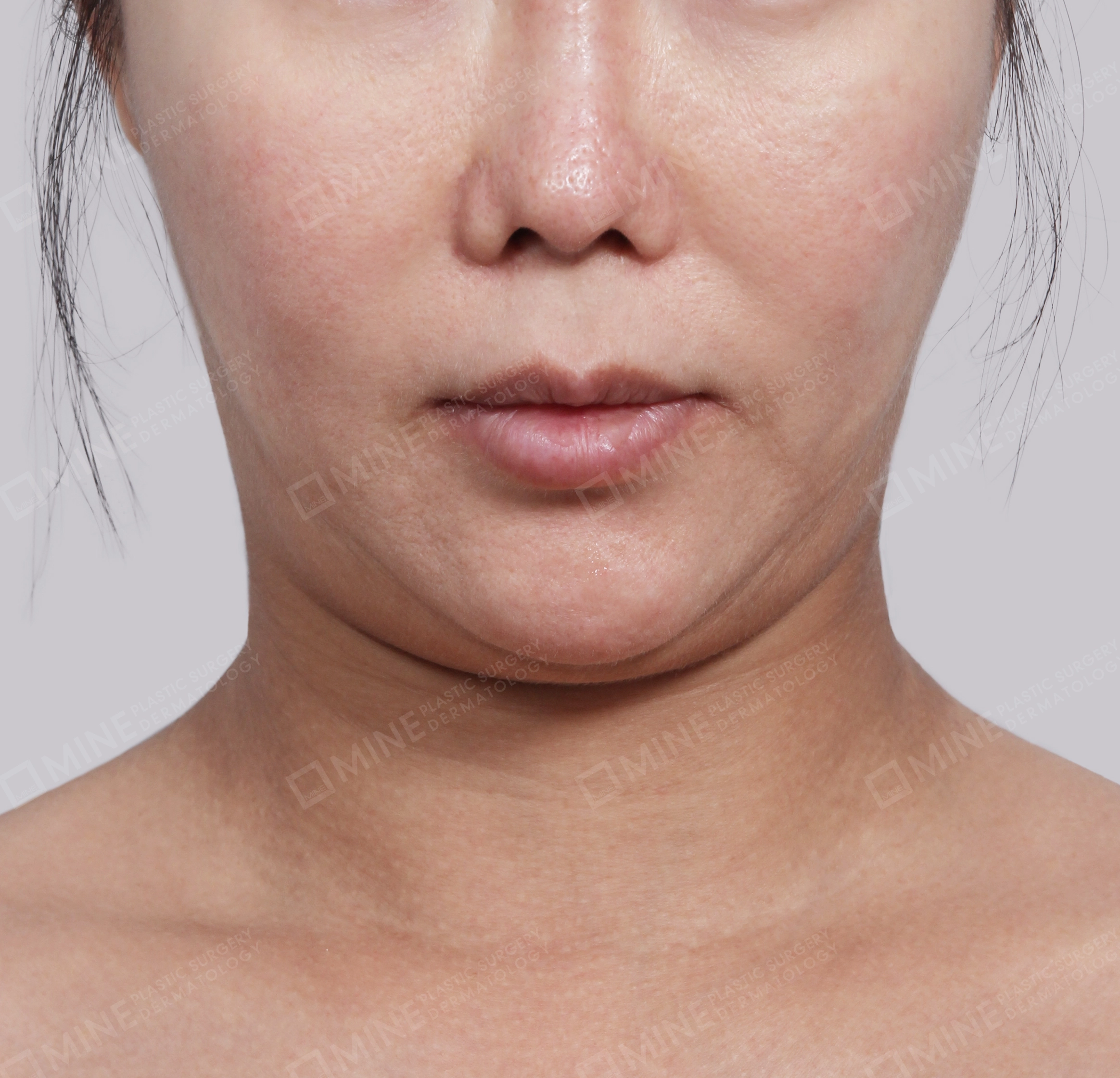Double Chin (Vlimming)-Front-Before