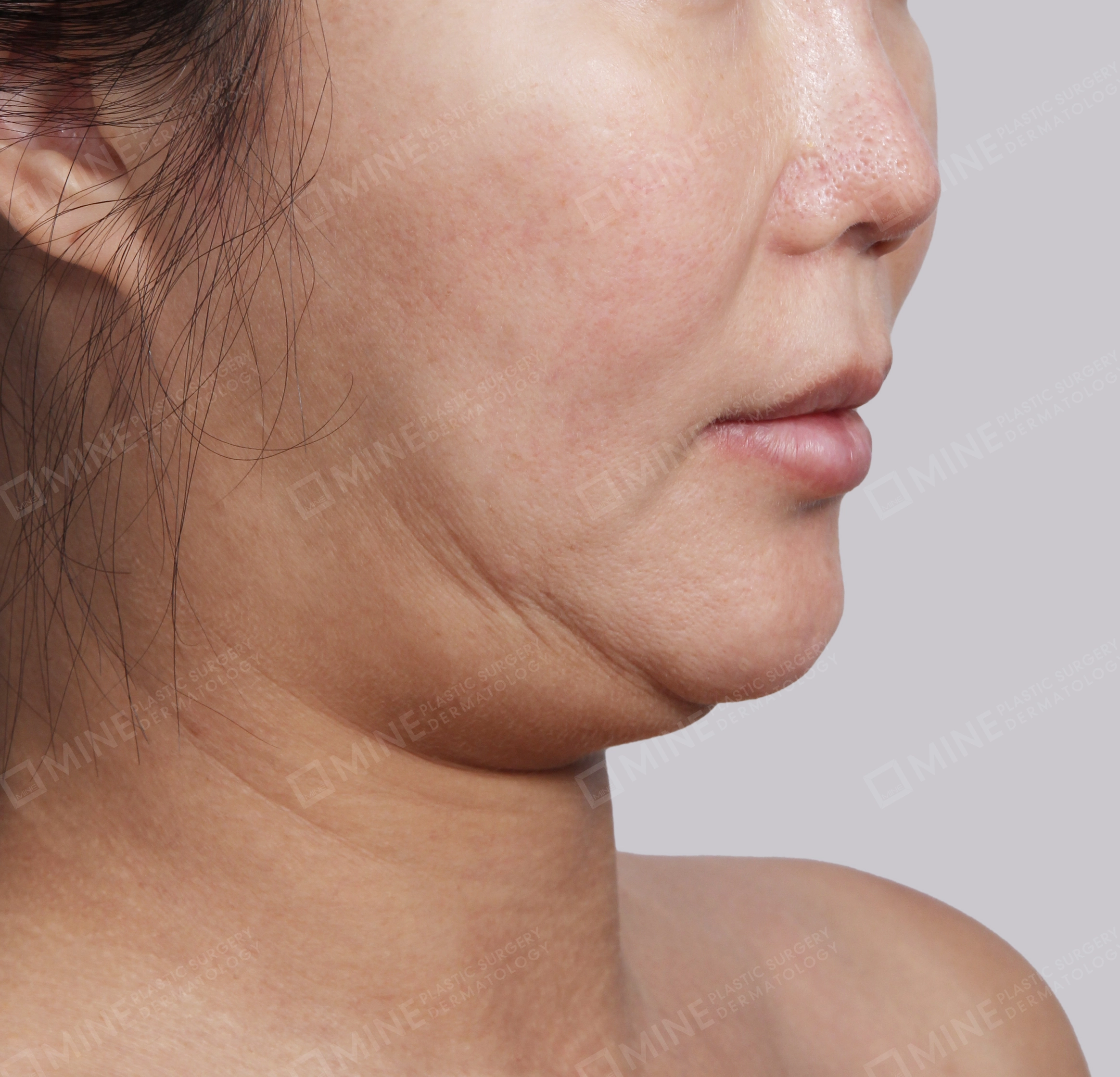 Double Chin (Vlimming)-45-Degree-Before