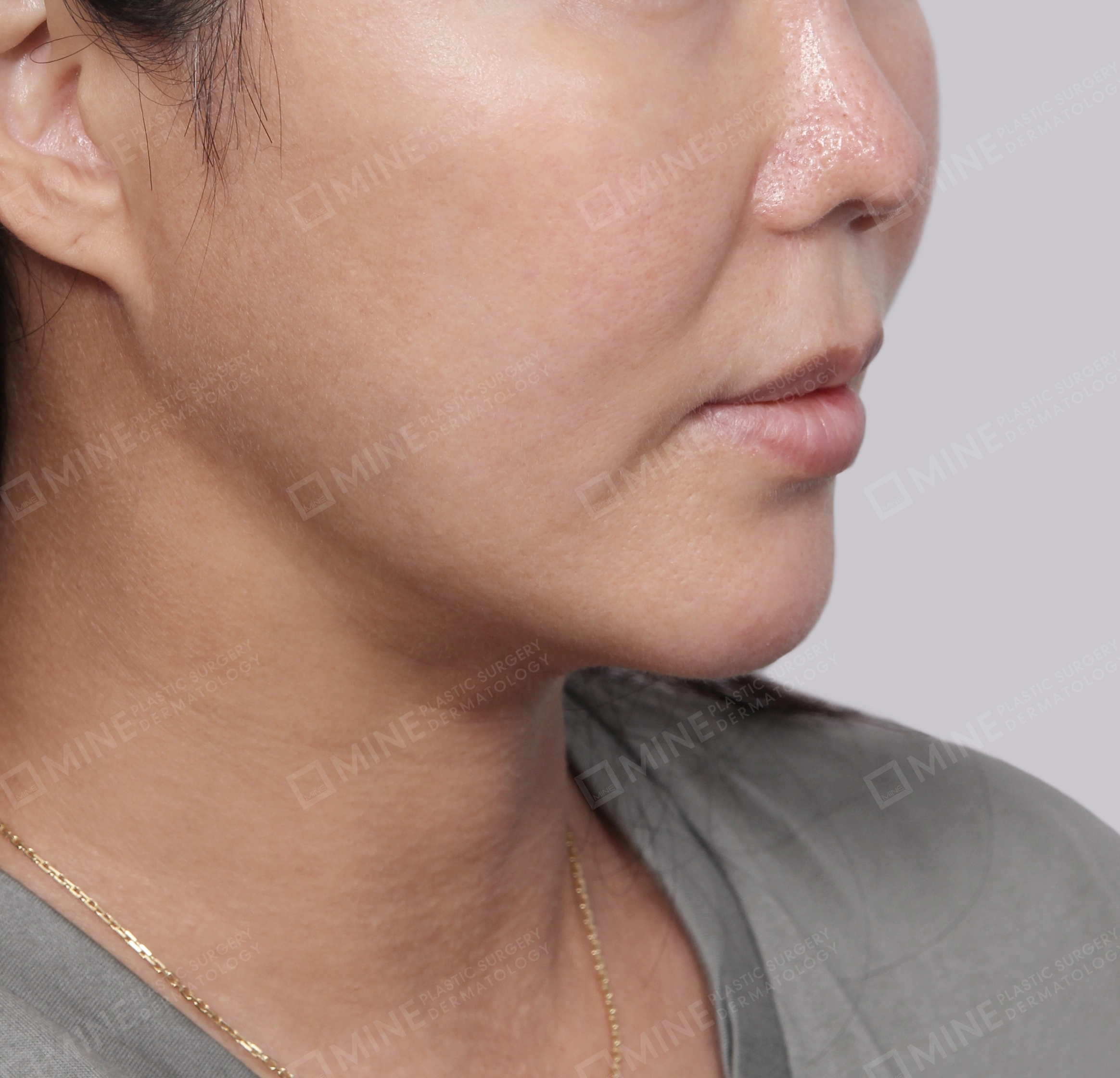 Double Chin (Vlimming)-45-Degree-After