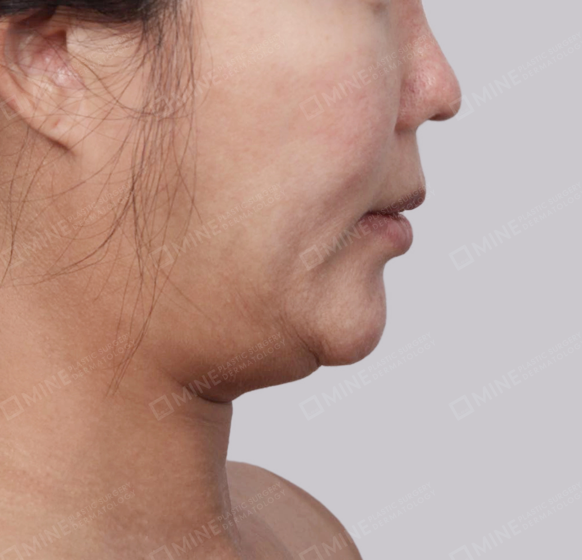 Double Chin (Vlimming)-Side-Before