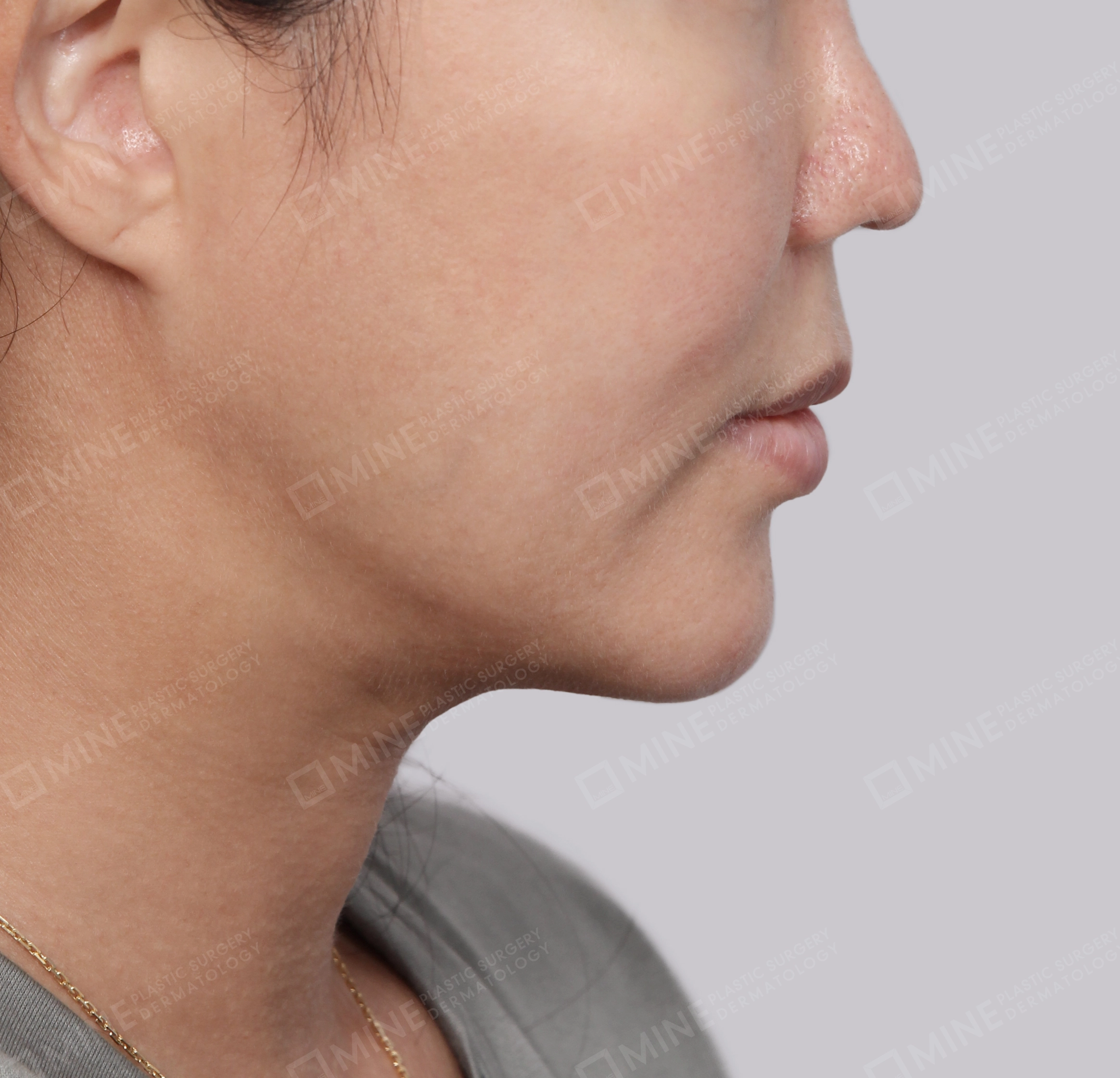 Double Chin (Vlimming)-Side-After
